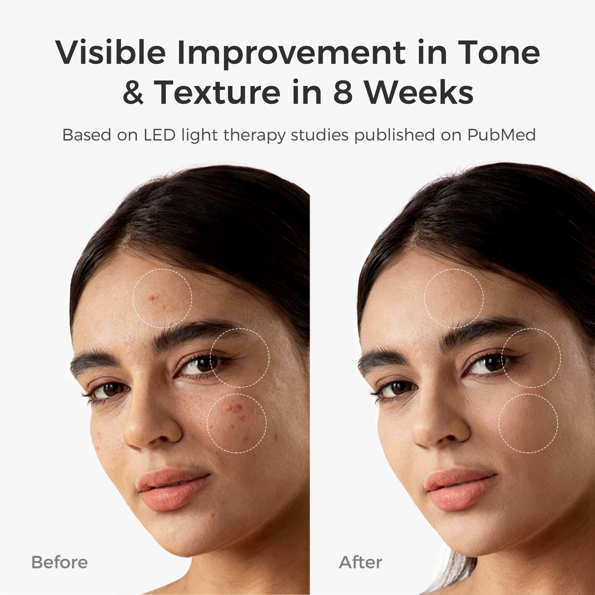 Visible Improvement in Tone & Texture in 8 Weeks  
Based on LED light therapy studies published on PubMed  

Before  
After