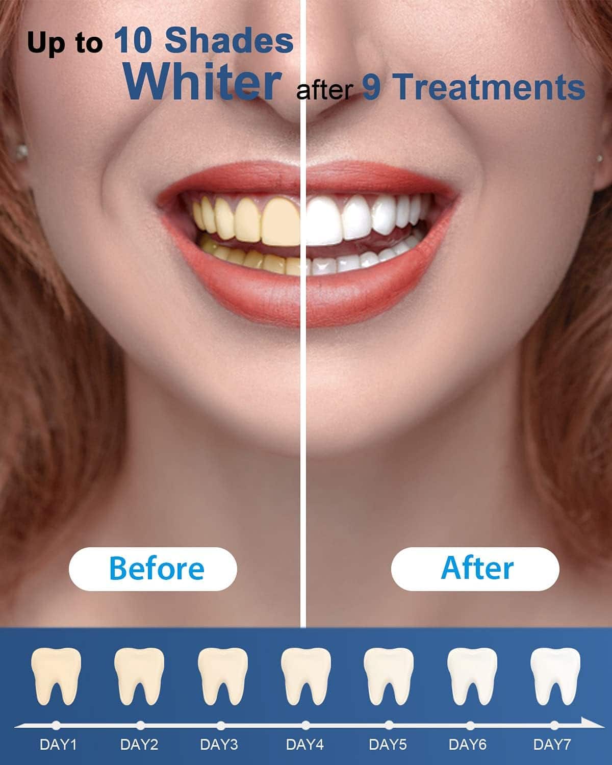 フェイスジェル・ゲル maa'sBIHAKU CLEAR Daily Whitening Gel MySmile Teeth Whitening Gel Refill Pack, 18% CP No Color 4-3-19C-M