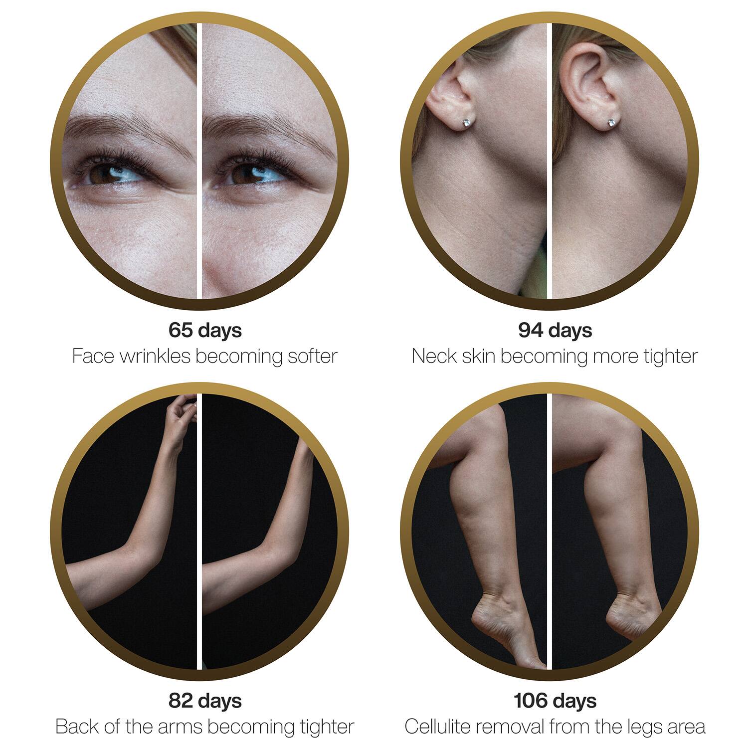 65 days  
Face wrinkles becoming softer  

94 days  
Neck skin becoming more tighter  

82 days  
Back of the arms becoming tighter  

106 days  
Cellulite removal from the legs area