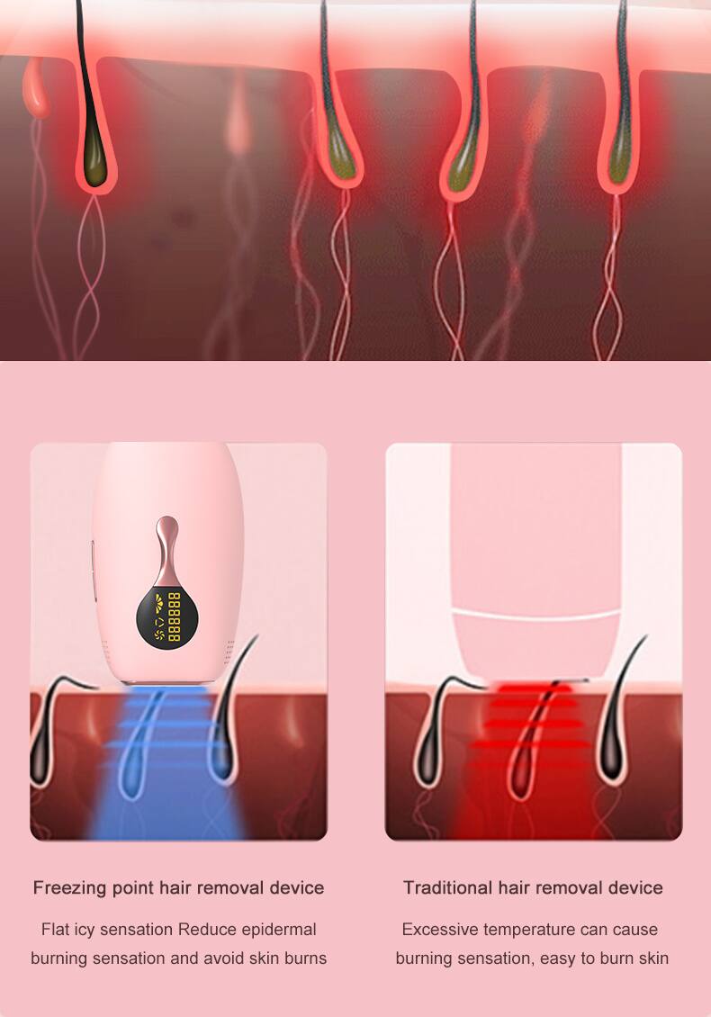 AT 888888 Freezing point hair removal device  
Traditional hair removal device  
Flat icy sensation  
Reduce epidermal burning sensation and avoid skin burns  
Excessive temperature can cause burning sensation, easy to burn skin