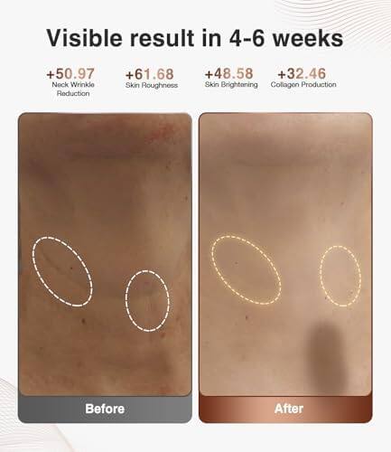 Visible result in 4-6 weeks

+50.97 Neck Wrinkle Reduction  
+61.68 Skin Roughness  
+48.58 Skin Brightening  
+32.46 Collagen Production  

Before After