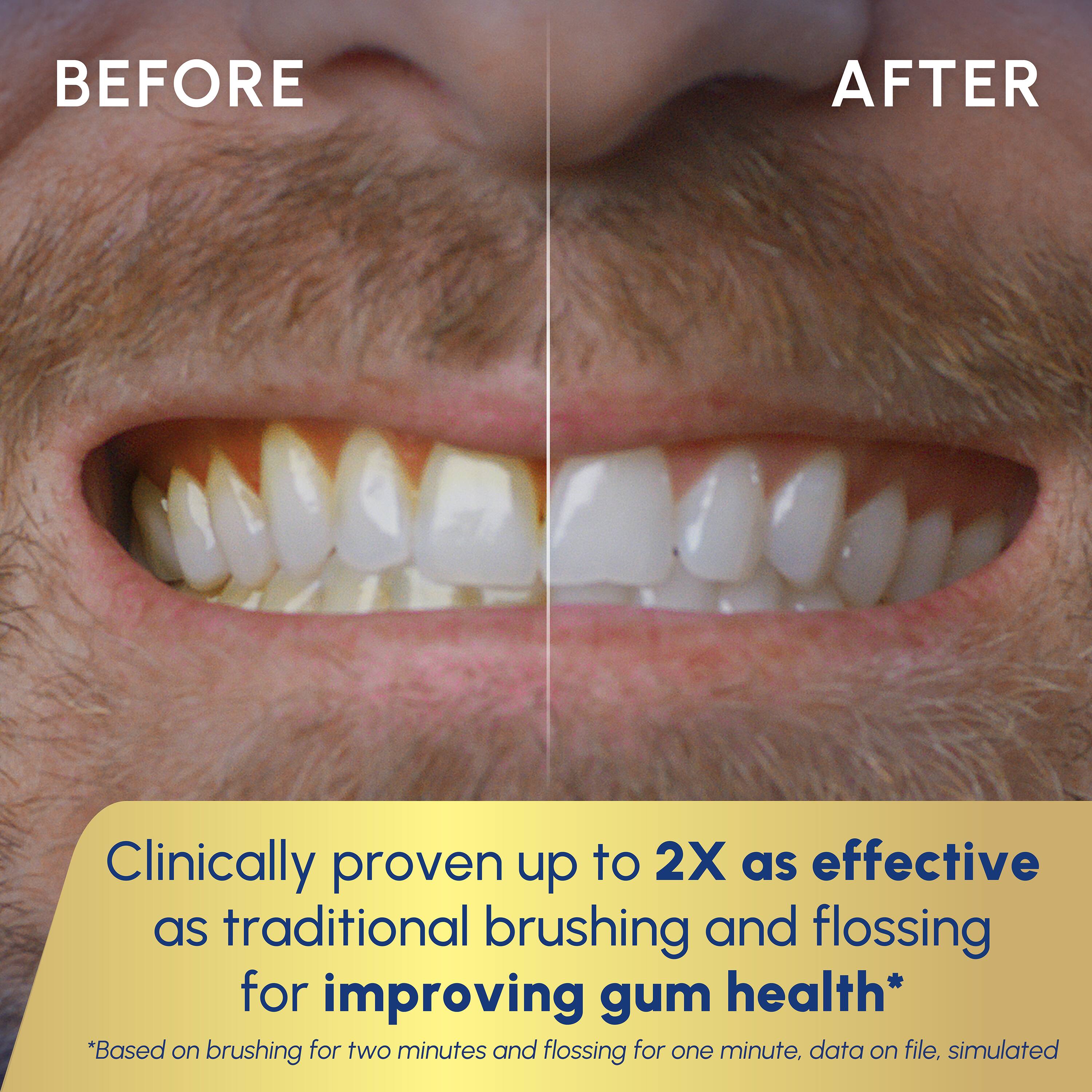 BEFORE  
AFTER  

Clinically proven up to 2X as effective as traditional brushing and flossing for improving gum health*  
*Based on brushing for two minutes and flossing for one minute, data on file, simulated