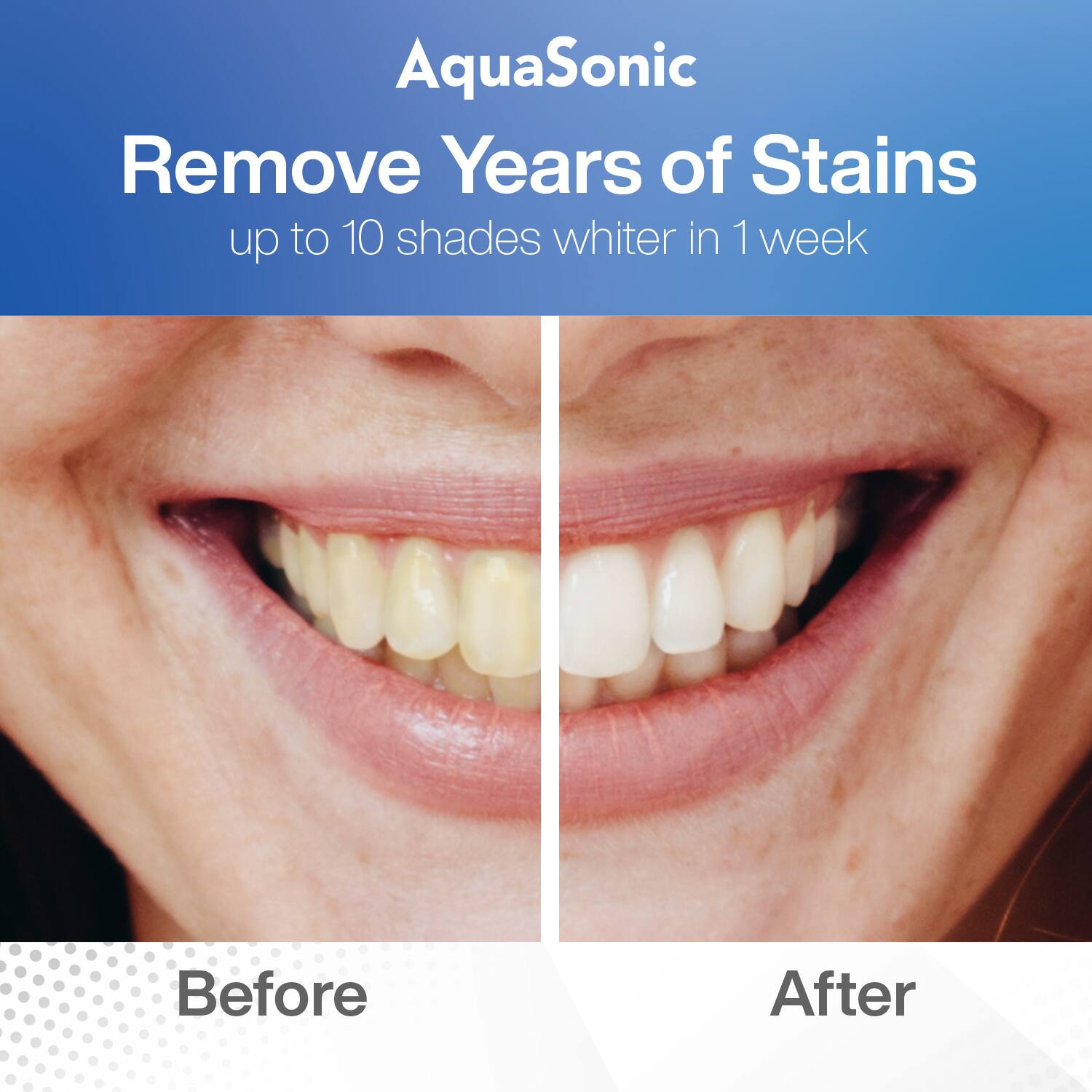AquaSonic  
Remove Years of Stains  
up to 10 shades whiter in 1 week  

Before  
After