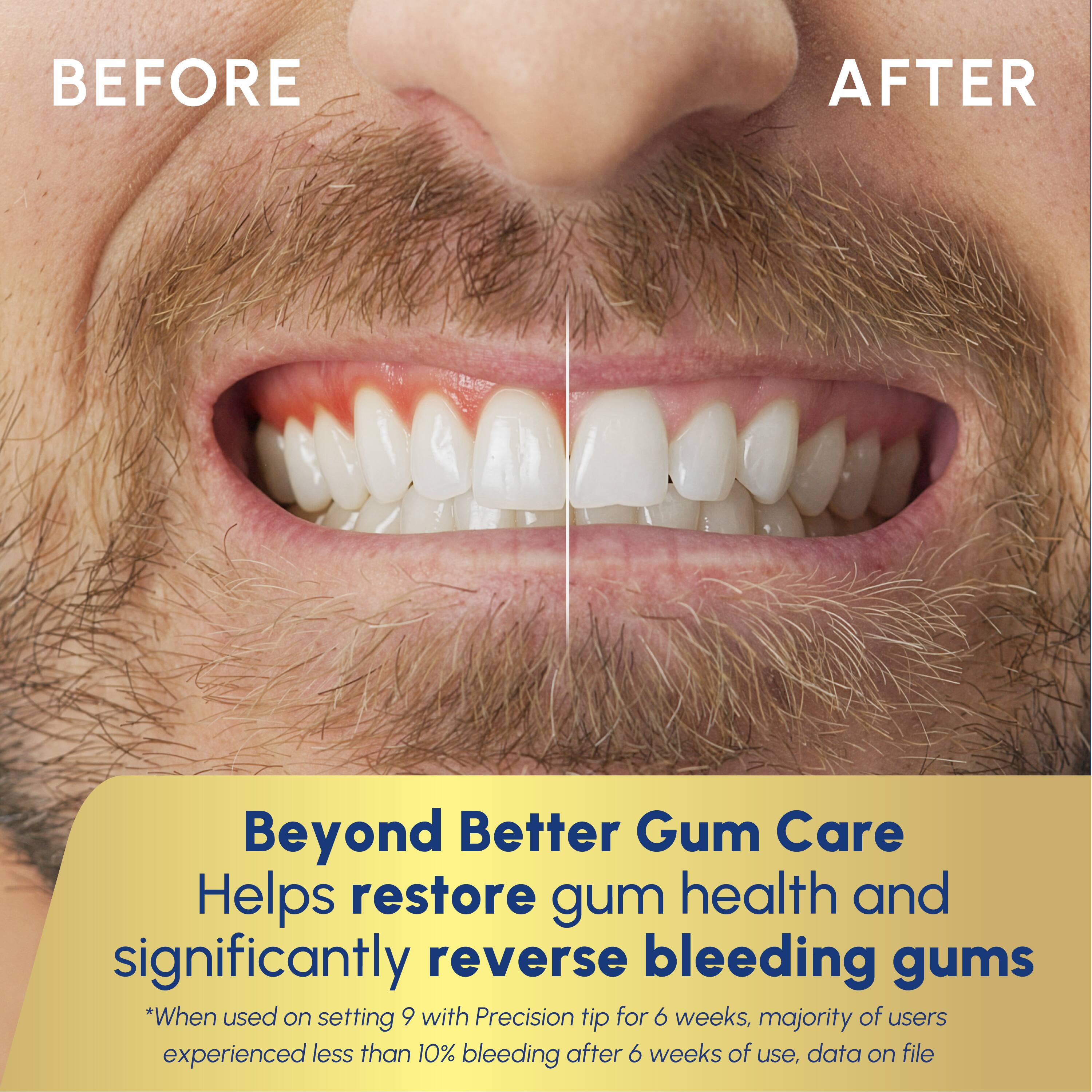 BEFORE AFTER

Beyond Better Gum Care  
Helps restore gum health and significantly reverse bleeding gums  
*When used on setting 9 with Precision tip for 6 weeks, majority of users experienced less than 10% bleeding after 6 weeks of use, data on file