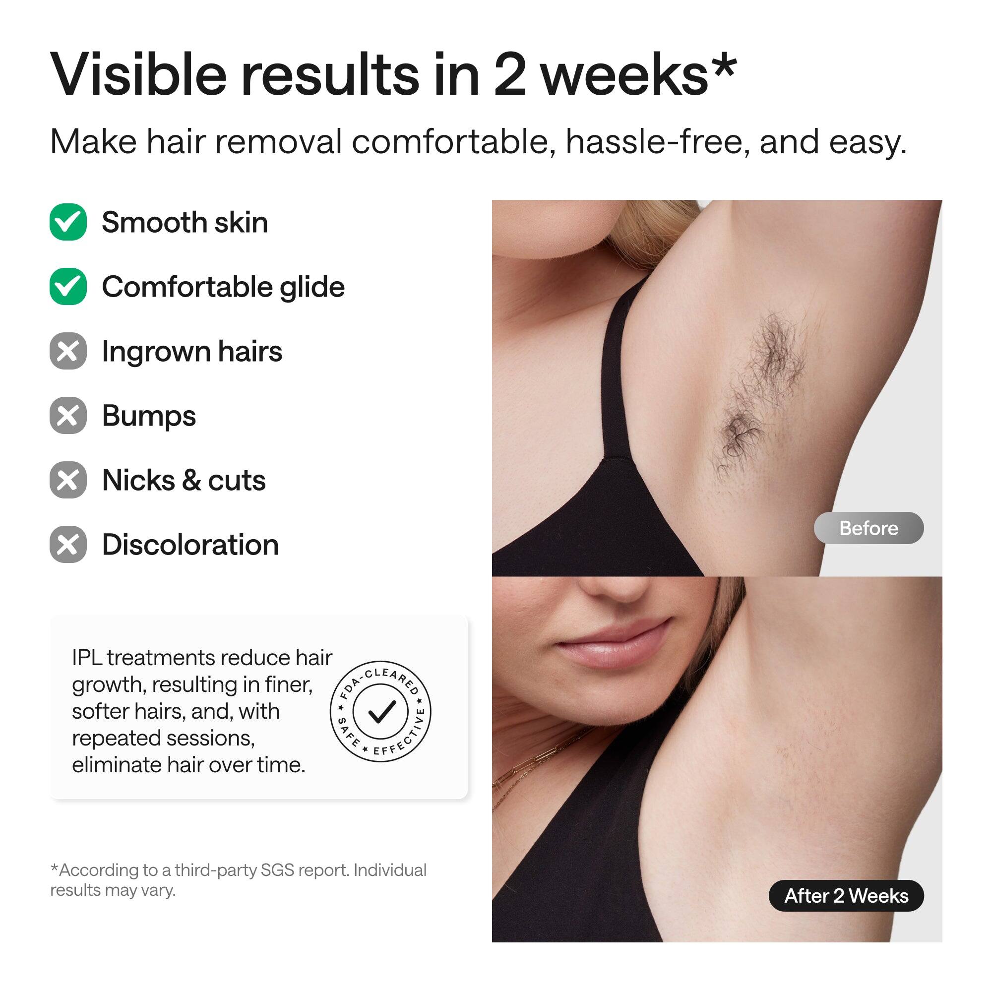 Visible results in 2 weeks*

Make hair removal comfortable, hassle-free, and easy.

- Smooth skin
- Comfortable glide
- Ingrown hairs
- Bumps
- Nicks & cuts
- Discoloration

IPL treatments reduce hair growth, resulting in finer, softer hairs, and, with repeated sessions, eliminate hair over time.

*According to a third-party SGS report. Individual results may vary.

After 2 Weeks