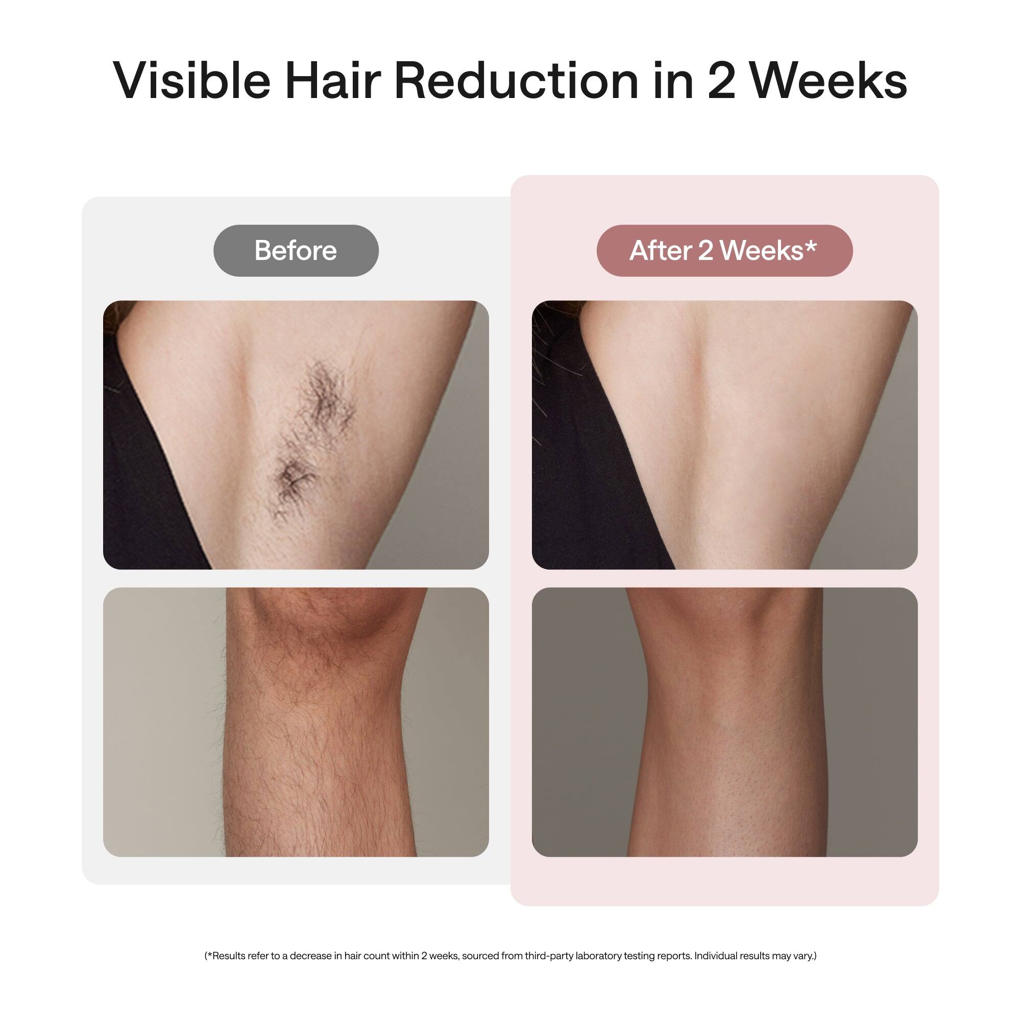 Visible Hair Reduction in 2 Weeks

Before

After 2 Weeks*

(*Results refer to a decrease in hair count within 2 weeks, sourced from third-party laboratory testing reports. Individual results may vary.)