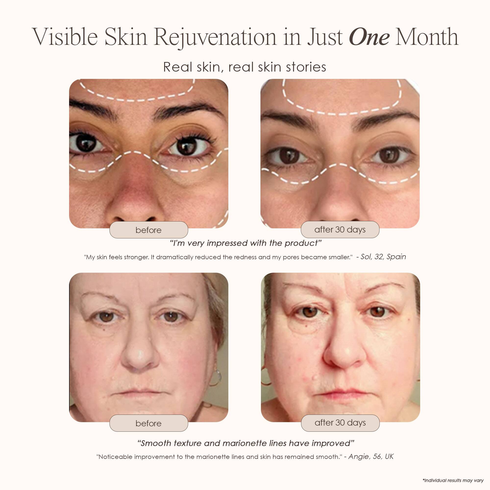 Visible Skin Rejuvenation in Just One Month  
Real skin, real skin stories  

before  
"I'm very impressed with the product"  
"My skin feels stronger. It dramatically reduced the redness and my pores became smaller."  
Sol, 32, Spain  

after 30 days  

before  
"Smooth texture and marionette lines have improved"  
"Noticeable improvement to the marionette lines and skin has remained smooth."  
Angie, 56, UK  

*Individual results may vary