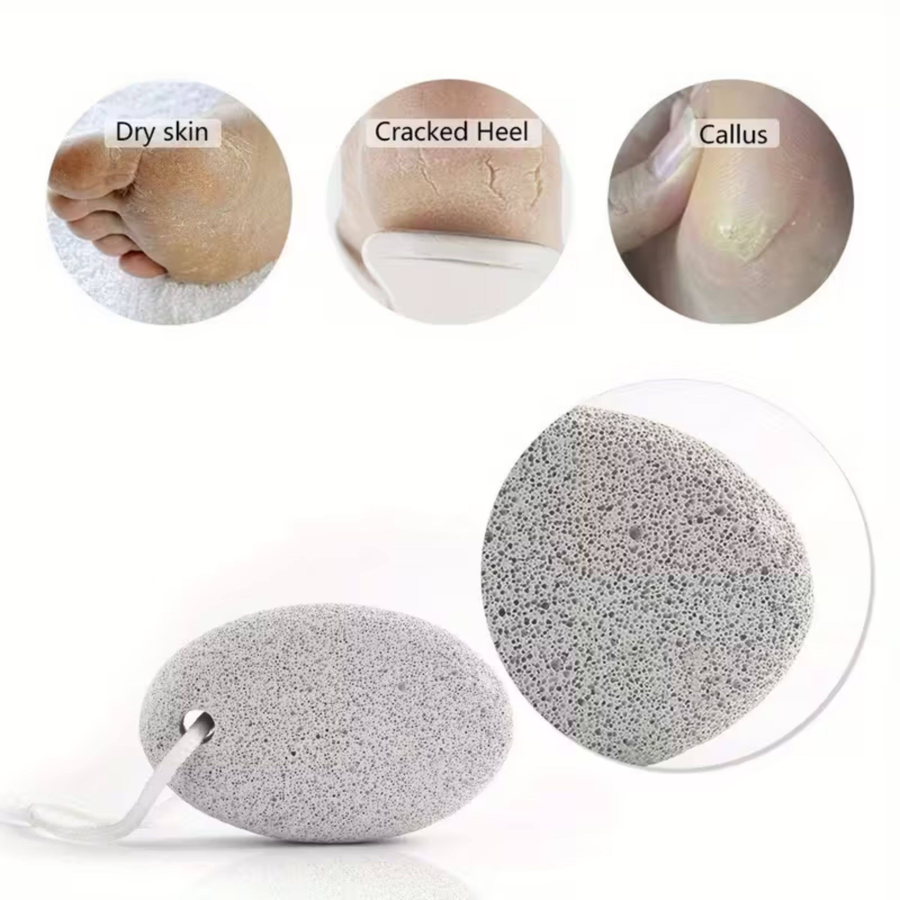 Dry skin  
Cracked Heel  
Callus