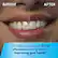 BEFORE AFTER
Clinically proven up to 2X as effective as string floss for improving gum health*
*data on file