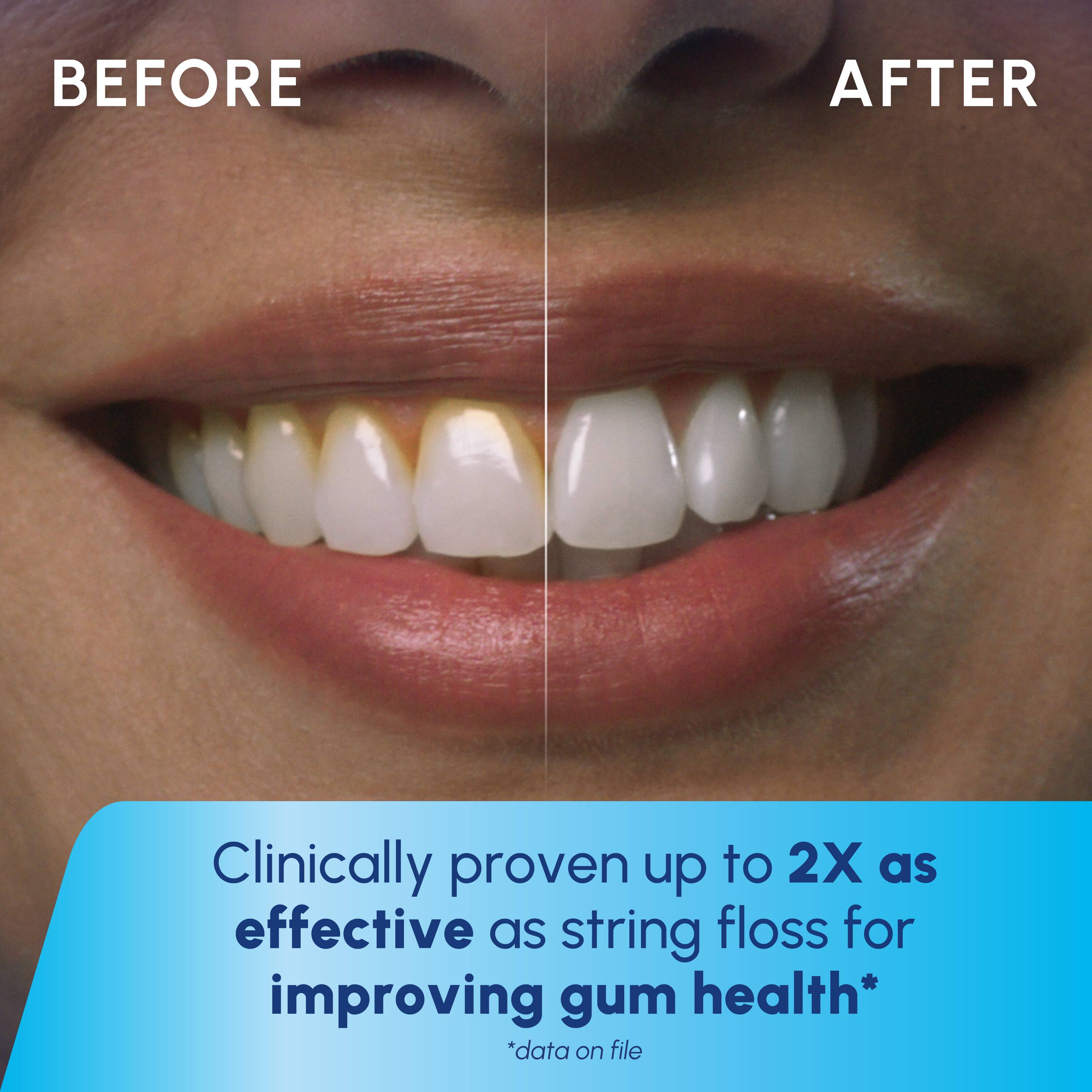 BEFORE AFTER

Clinically proven up to 2X as effective as string floss for improving gum health*  
*data on file