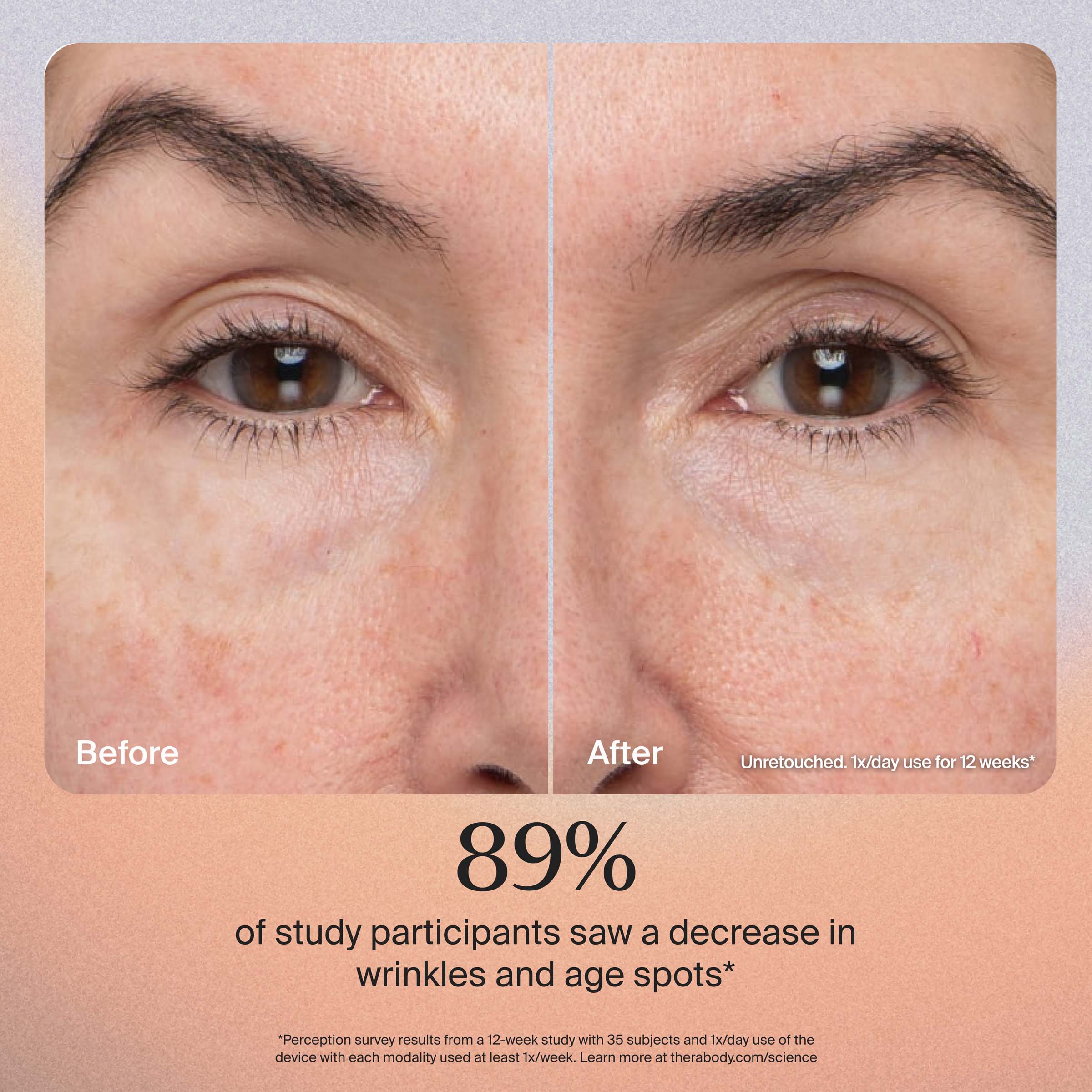 Before After Unretouched. 1x/day use for 12 weeks*

89% of study participants saw a decrease in wrinkles and age spots*

*Perception survey results from a 12-week study with 35 subjects and 1x/day use of the device with each modality used at least tx/week. Learn more at therabody.com/science