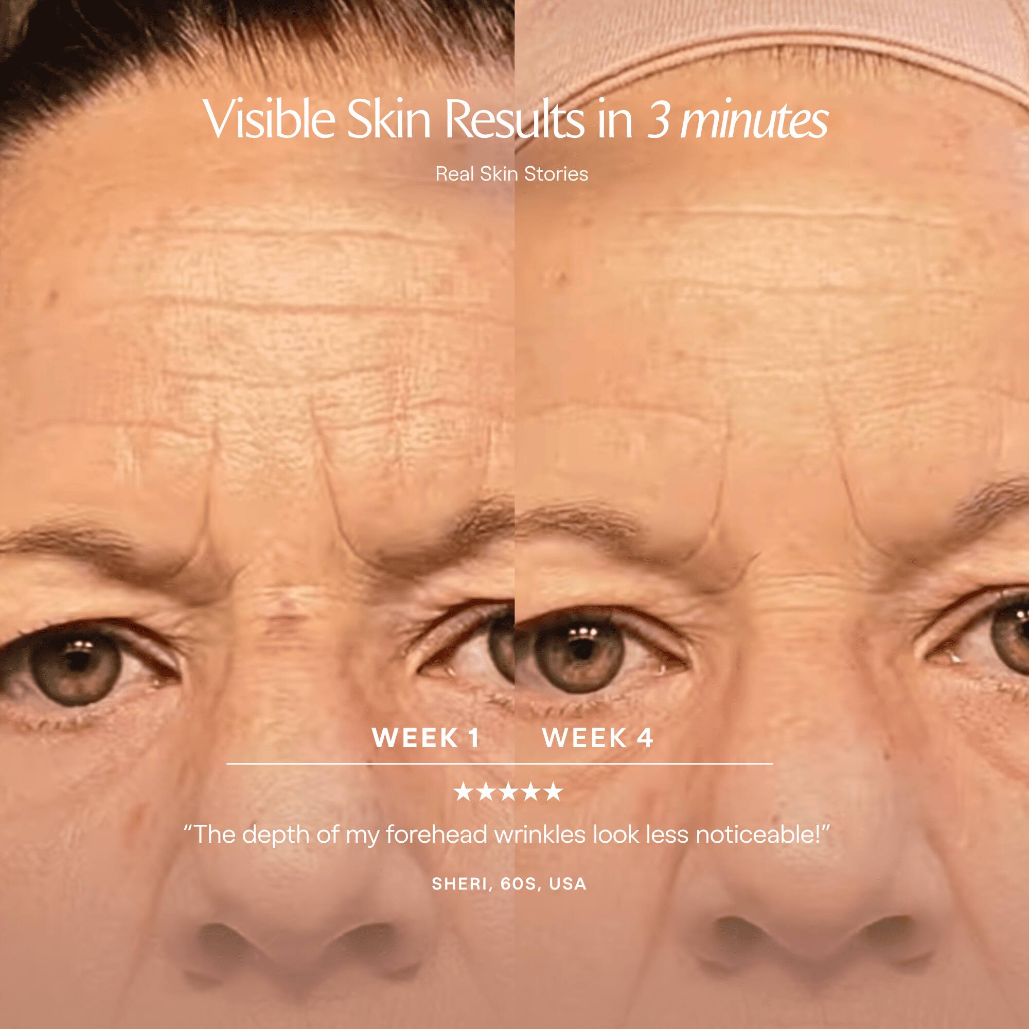 Visible Skin Results in 3 minutes  
Real Skin Stories  

WEEK 1  
WEEK 4  

"The depth of my forehead wrinkles look less noticeable!"  
SHERI, 60s, USA