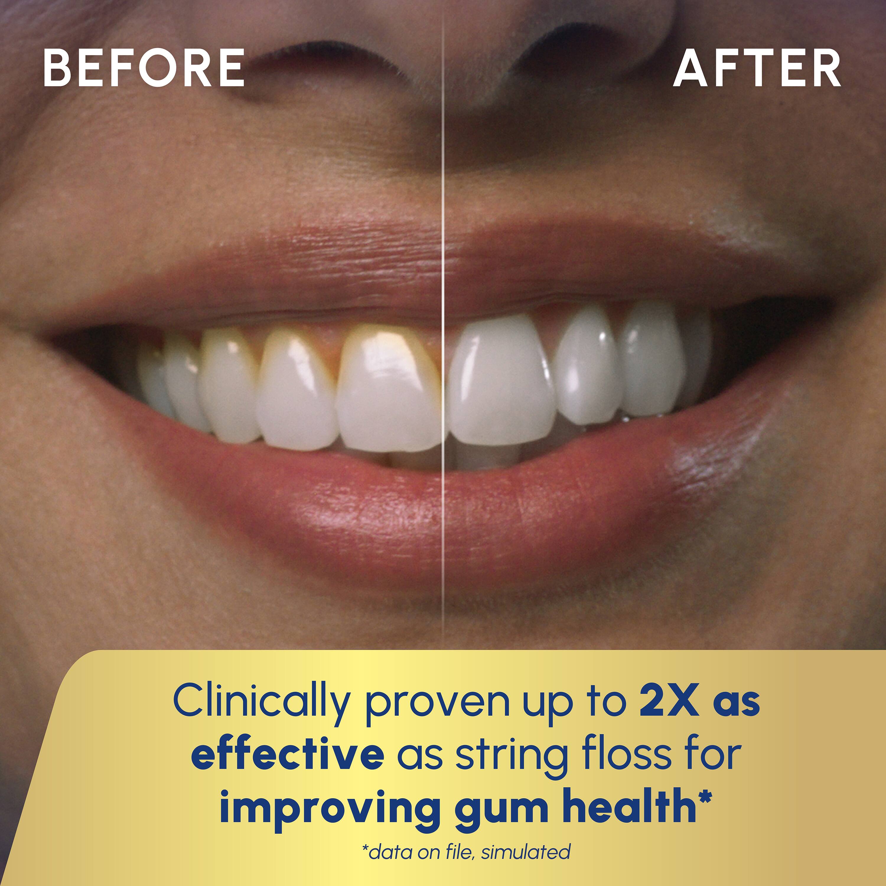 BEFORE AFTER

Clinically proven up to 2X as effective as string floss for improving gum health*  
*data on file, simulated
