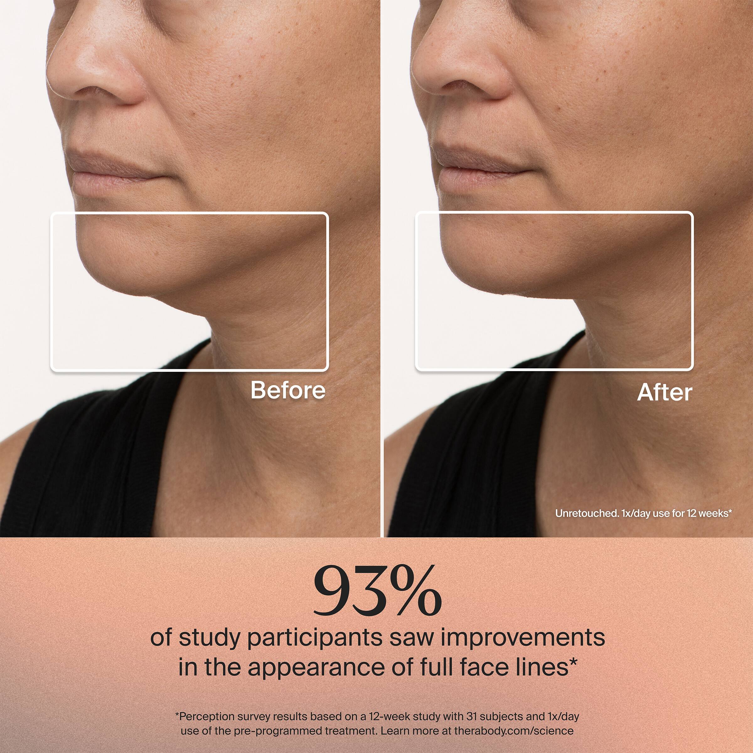 Before After  
Unretouched. 1x/day use for 12 weeks*  

93%  
of study participants saw improvements in the appearance of full face lines*  

*Perception survey results based on a 12-week study with 31 subjects and 1x/day use of the pre-programmed treatment. Learn more at therabody.com/science