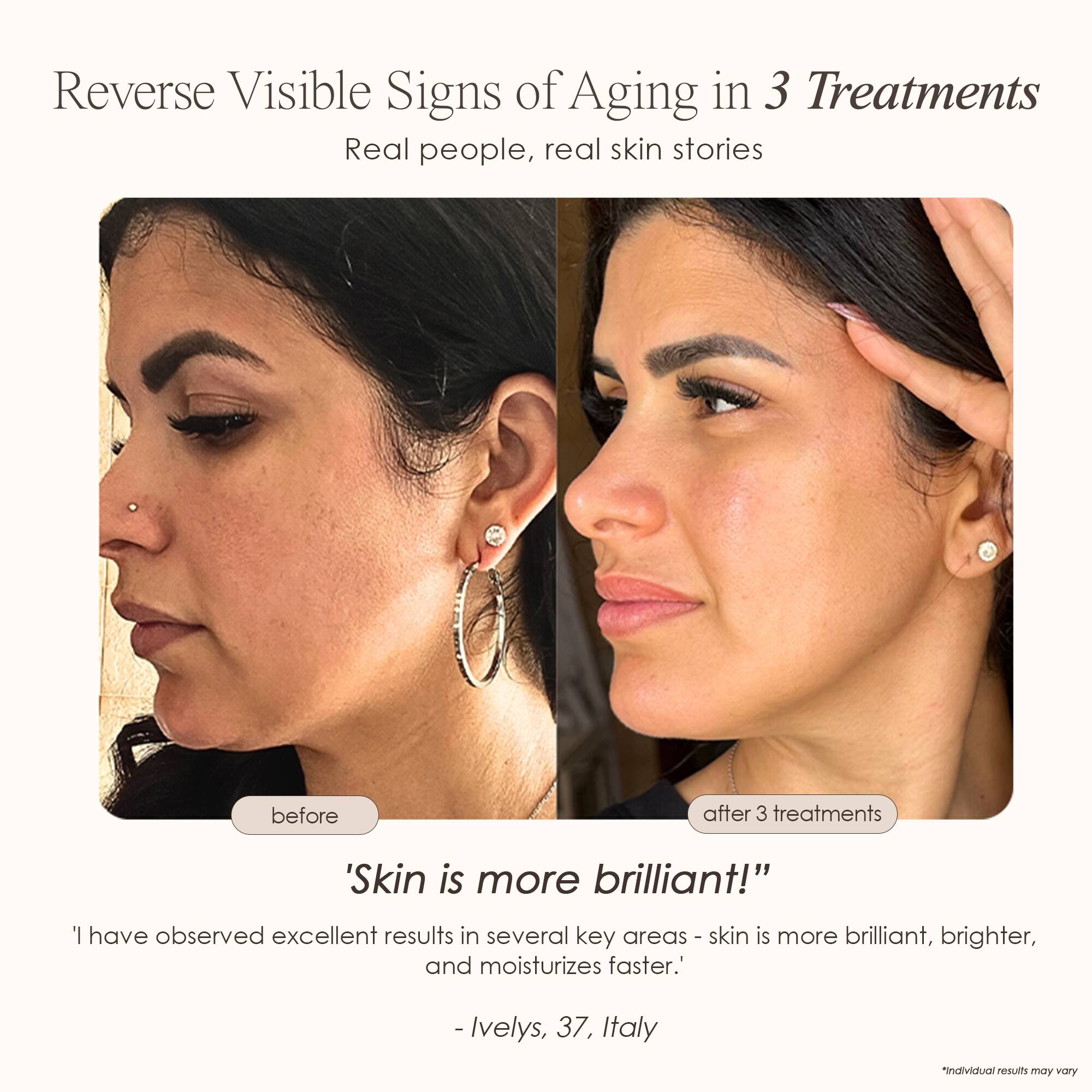 Reverse Visible Signs of Aging in 3 Treatments  
Real people, real skin stories  

before  
after 3 treatments  

'Skin is more brilliant!'  

'I have observed excellent results in several key areas - skin is more brilliant, brighter, and moisturizes faster.'  
- Ivelys, 37, Italy  

*Individual results may vary