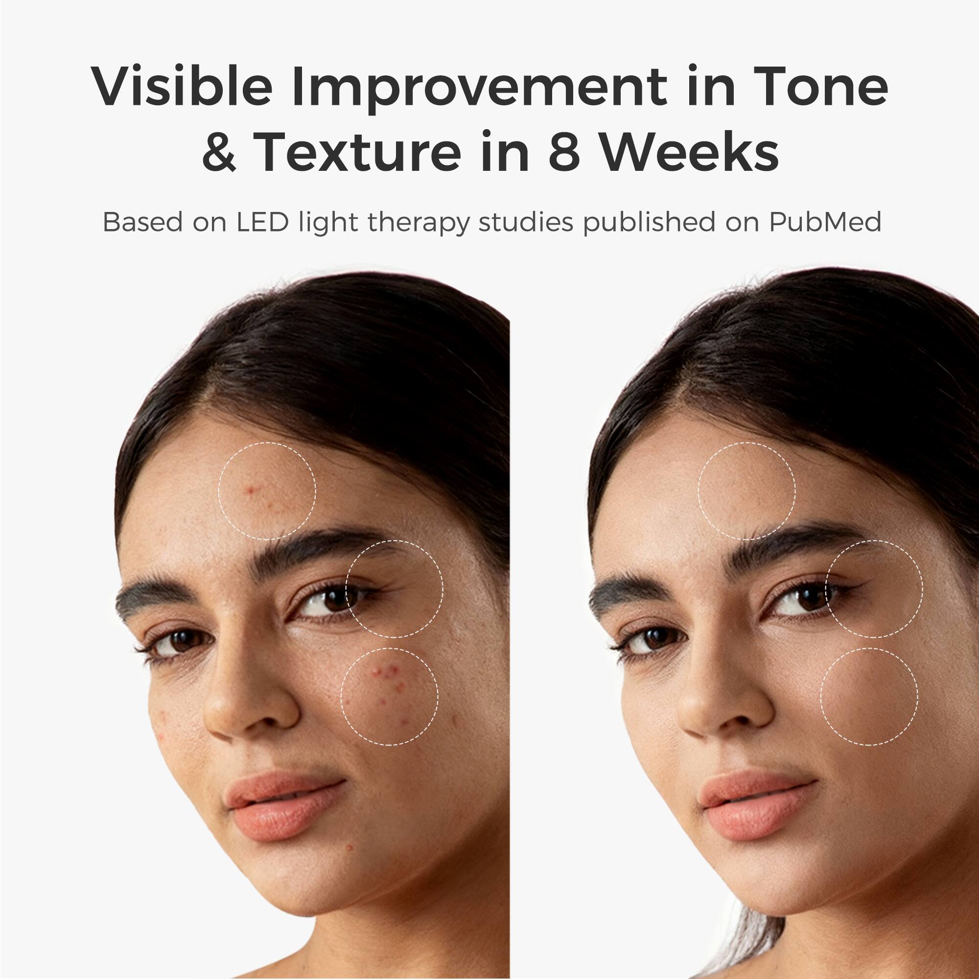 Visible Improvement in Tone & Texture in 8 Weeks  
Based on LED light therapy studies published on PubMed