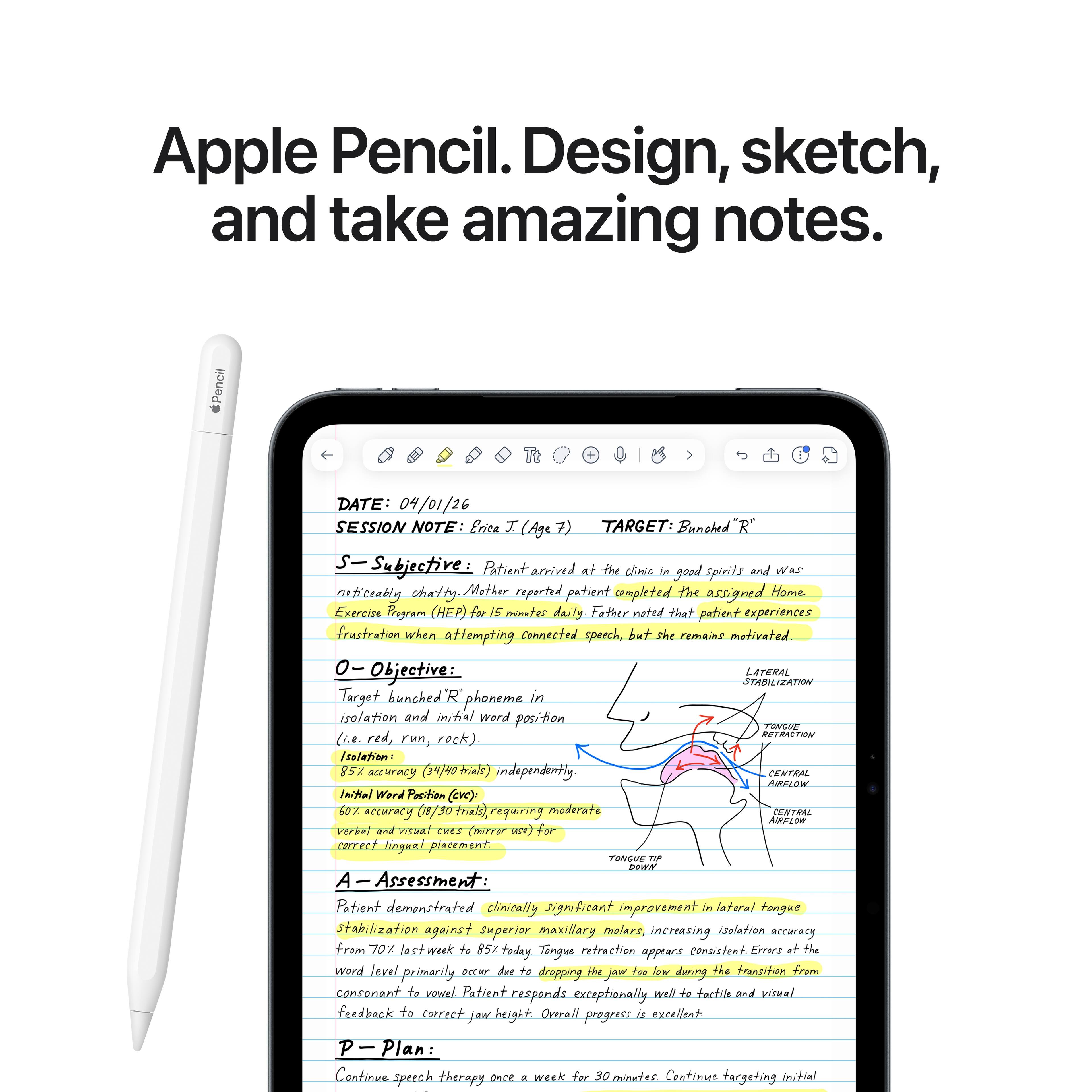 Apple Pencil. Design, sketch, and take amazing notes.

Pencil

DATE: 04/01/26
SESSION NOTE: Erica I (Age 7) TARGET: Bunched R" 
S-Subjective: Patient arrived at the clinic in good spirits and was noticeably chatty. Mother reported patient completed the assigned Home Exercise Program (HEP) for 15 minutes daily. Father noted that patient experiences frustration when attempting connected speech, but she remains motivated.
O-Objective: LATERAL STABILIZATION Target bunched 'R" phoneme in isolation and initial word position (i.e. run, rock) Isolation: 85% accuracy independently. CENTRAL AIRFLOW Initial Word Position (eve). 60% accuracy (18/30 trials), requiring moderate CENTRAL AIRFLOW verbal and visual cues (mirror for correct lingual placement. TONGUE TIP DOWN
A-Assessment: Patient demonstrated clinically significant improvement in lateral tongue stabilization against superior maxillary molars, increasing isolation accuracy from 70% last week to 85% today. TONGUE RETRACTION appears consistent. Errors at the word level primarily occur due to dropping the jaw too low during the transition from conson