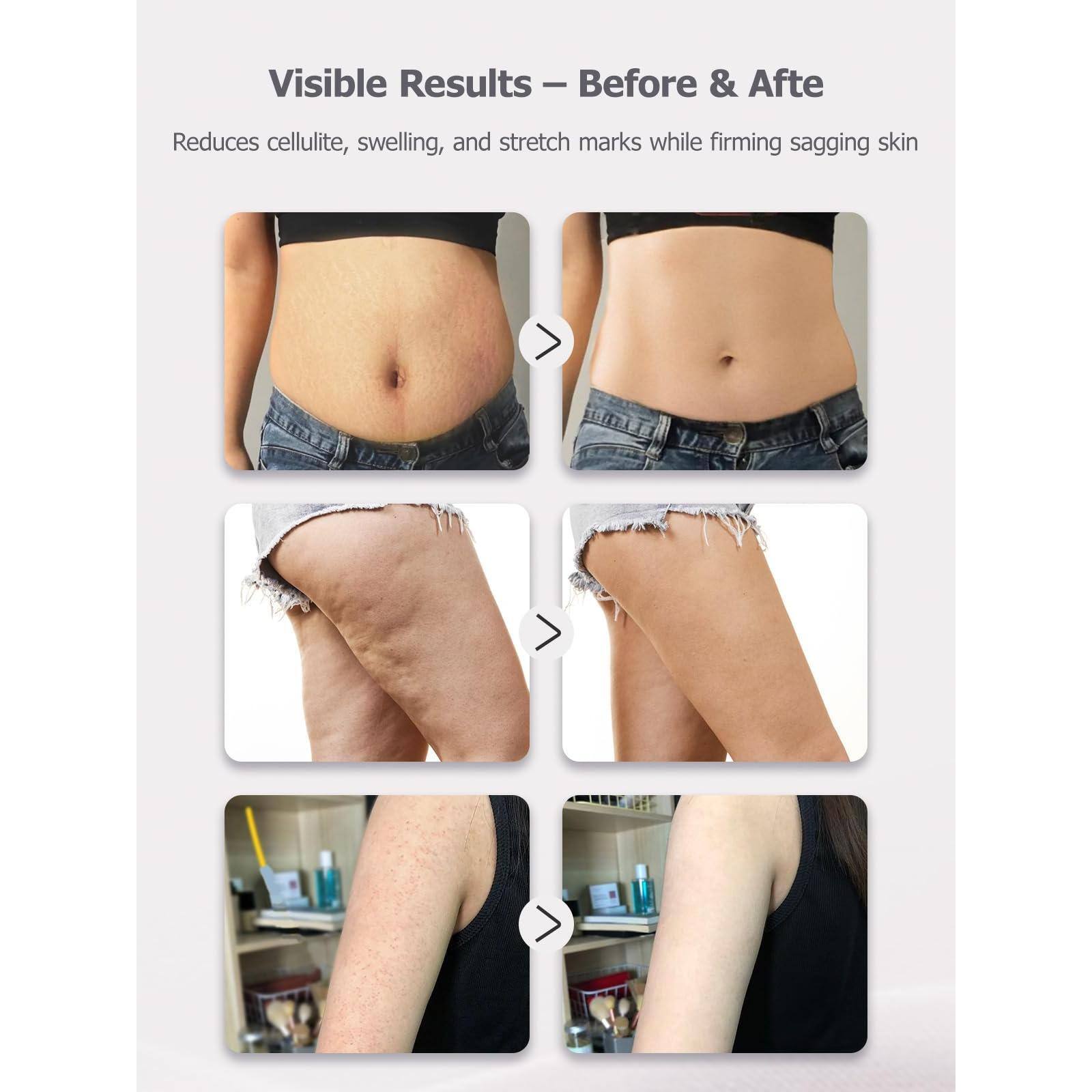 Visible Results - Before & After

Reduces cellulite, swelling, and stretch marks while firming sagging skin