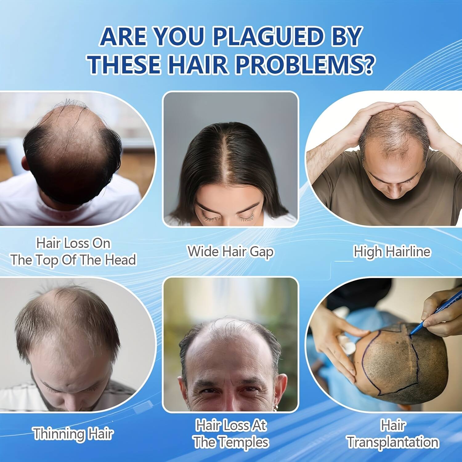 ARE YOU PLAGUED BY THESE HAIR PROBLEMS?
- Hair Loss On The Top Of The Head
- Wide Hair Gap
- High Hairline
- Thinning Hair
- Hair Loss At The Temples
- Hair Transplantation