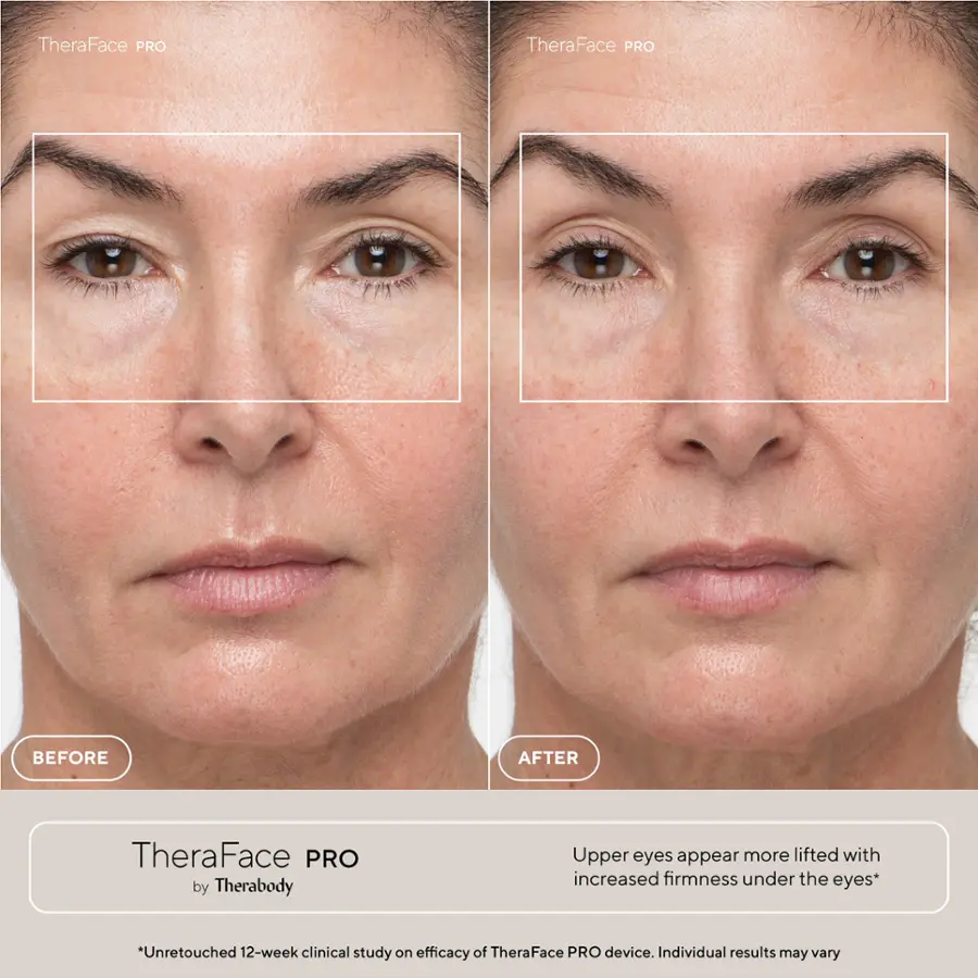 TheraFace PRO is a device that can help improve the appearance of the upper eyes by lifting and firming the under-eye area. A 12-week clinical study was conducted to assess the efficacy of this device, and individual results may vary. The image shows a before and after comparison of a woman's face, with the after picture showing the potential results of using TheraFace PRO.