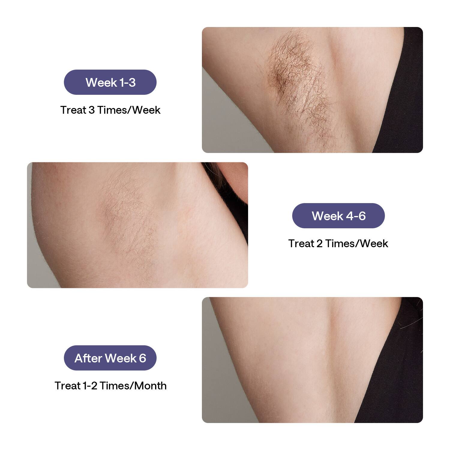 The image shows a woman's back with hair loss, and it is divided into three sections. The first section displays the woman's back with hair loss, while the second and third sections show the progress of hair growth after treatment. The image also includes text that explains the treatment schedule for different weeks, such as "Week 1-3 Treat 3 Times/Week" and "Week 4-6 Treat 2 Times/Week." The text also indicates that after week 6, the treatment schedule changes to "Treat 1-2 Times/Month."