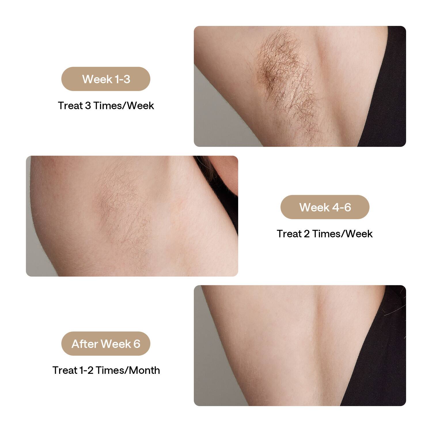 The image shows a woman's back with a hairless area, likely due to a medical condition. The image is divided into three sections, each displaying different stages of the woman's condition. The text accompanying the image provides information on the treatment schedule for each stage.

For Week 1-3, the treatment schedule is to treat the area three times a week. For Week 4-6, the treatment schedule is to treat the area two times a week. After Week 6, the treatment schedule is to treat the area one to two times a month.