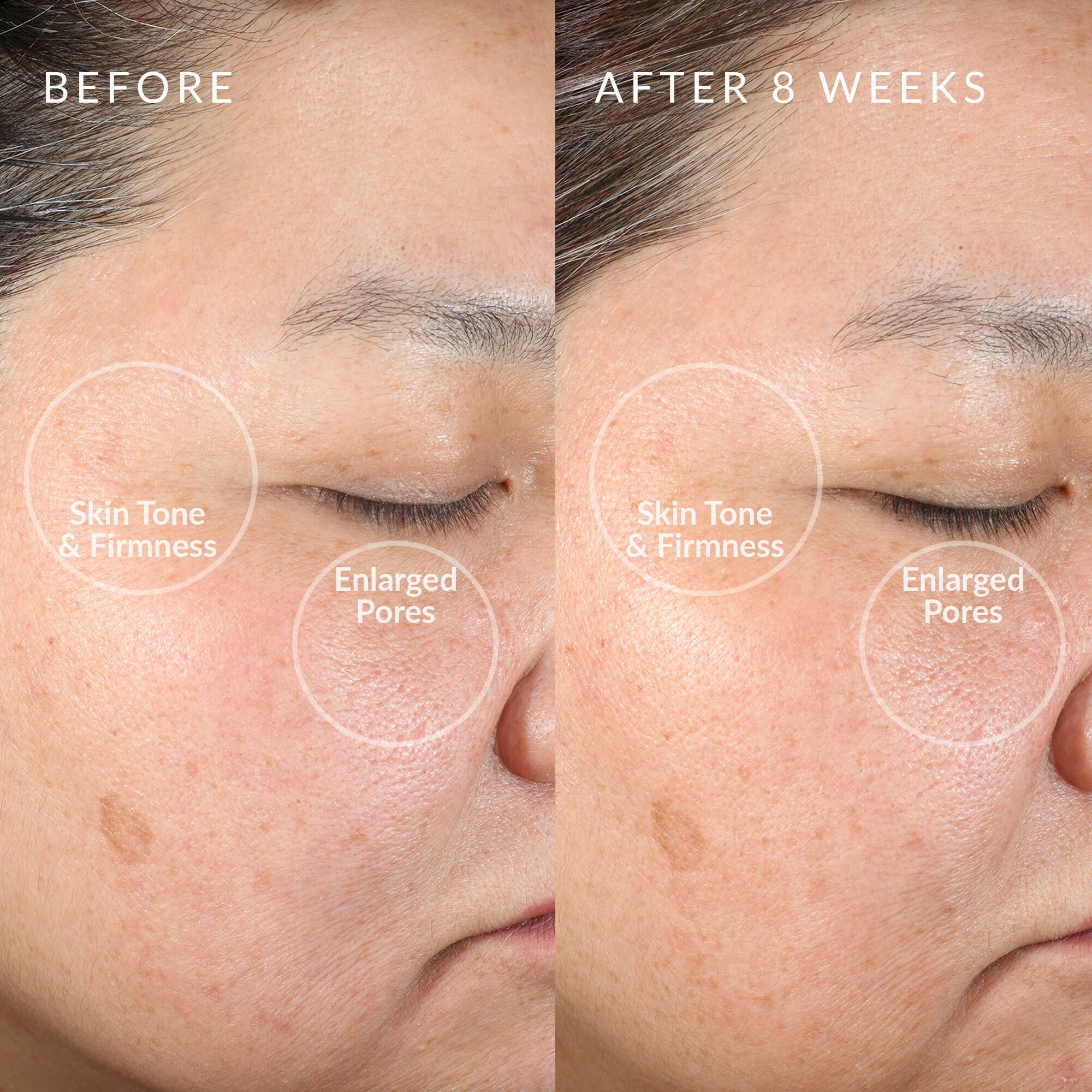 BEFORE AFTER 8 WEEKS Skin Tone & Firmness Enlarged Pores Skin Tone & Firmness Enlarged Pores
