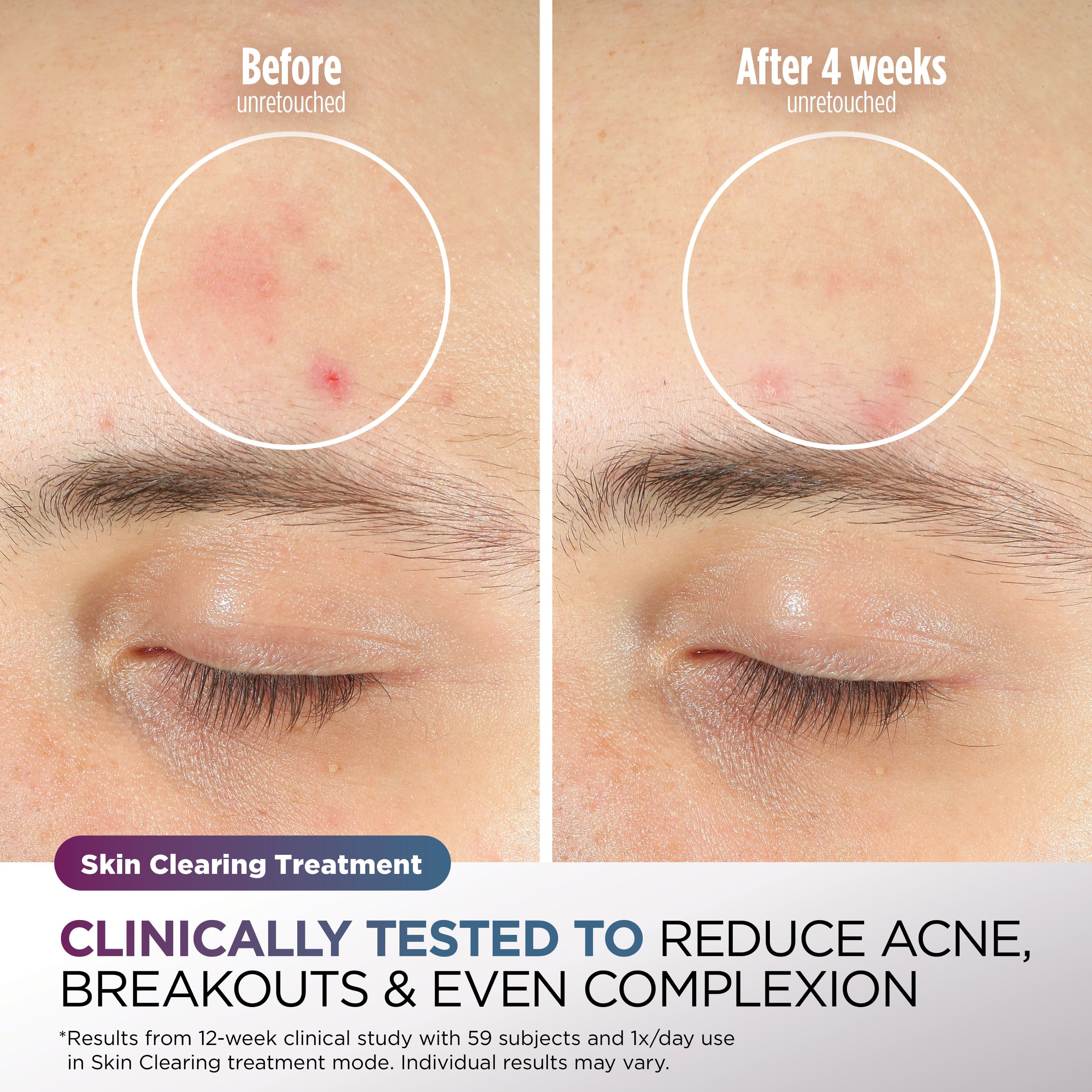 Before unretouched, After 4 weeks unretouched. Skin Clearing Treatment. CLINICALLY TESTED TO REDUCE ACNE, BREAKOUTS & EVEN COMPLEXION. *Results from 12-week clinical study with 59 subjects and 1x/day use in Skin Clearing treatment mode. Individual results may vary.