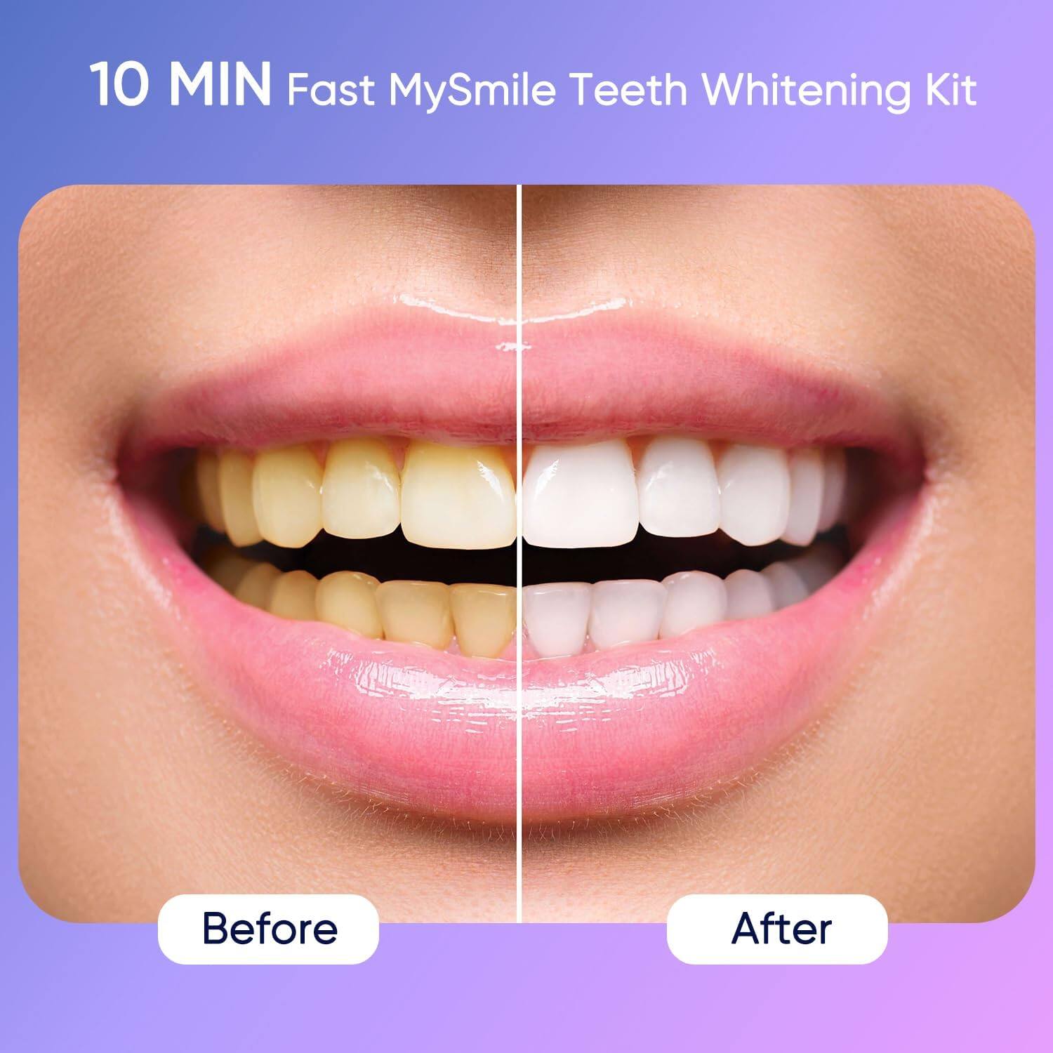 10 MIN Fast MySmile Teeth Whitening Kit
Before After