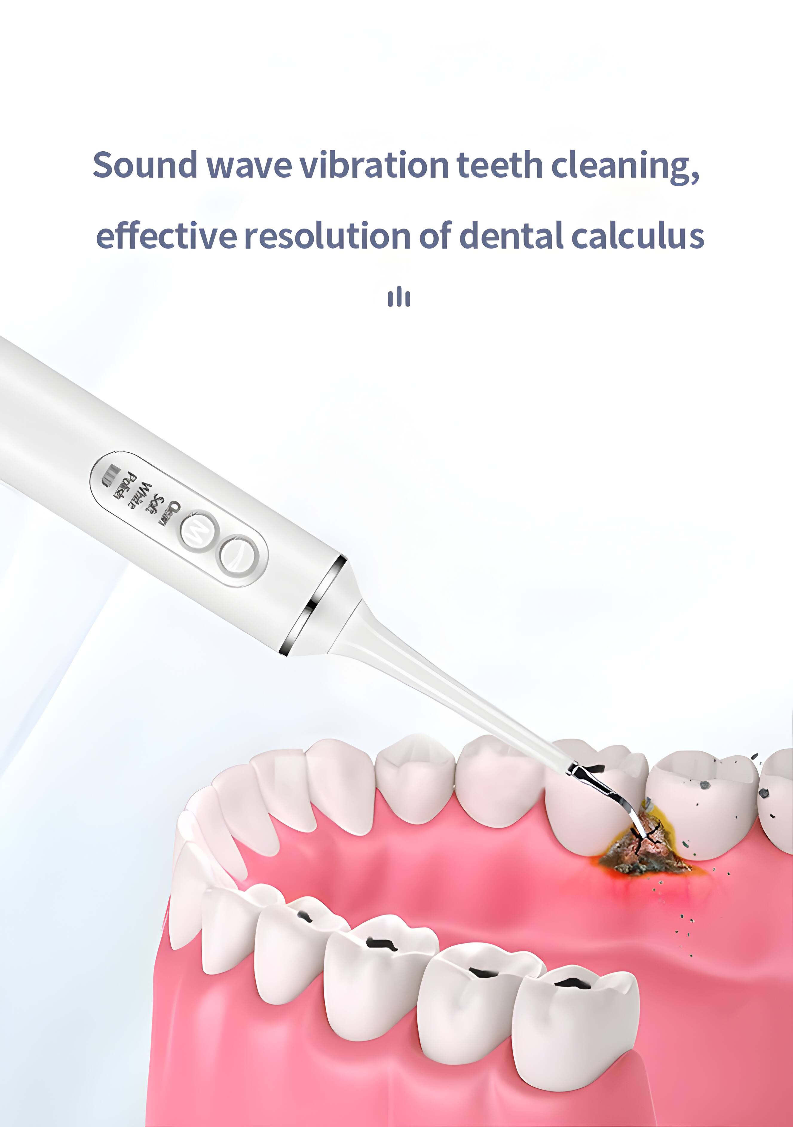 Sound wave vibration teeth cleaning, effective resolution of dental calculus