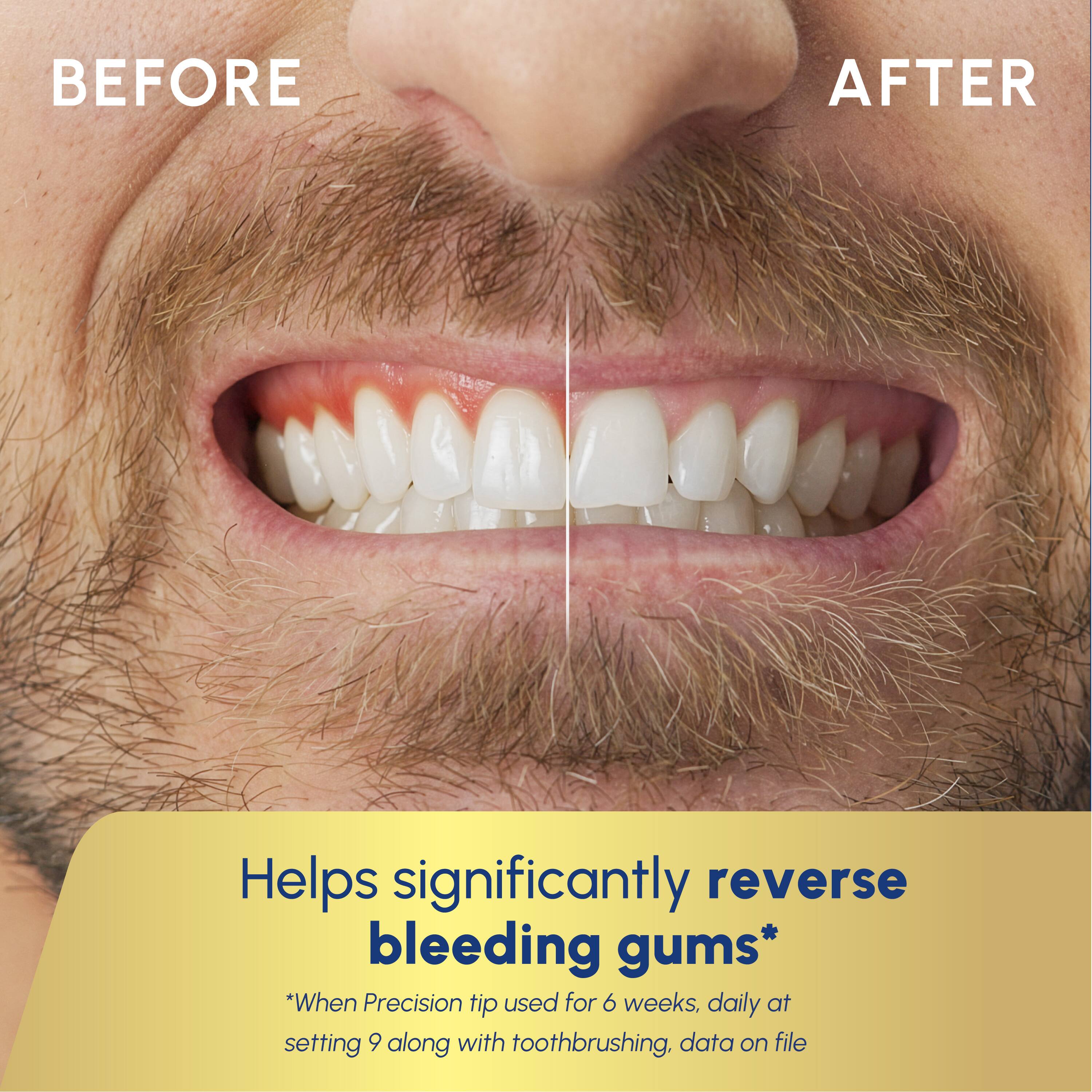 BEFORE AFTER

Helps significantly reverse bleeding gums*
*When Precision tip used for 6 weeks, daily at setting 9 along with toothbrushing, data on file