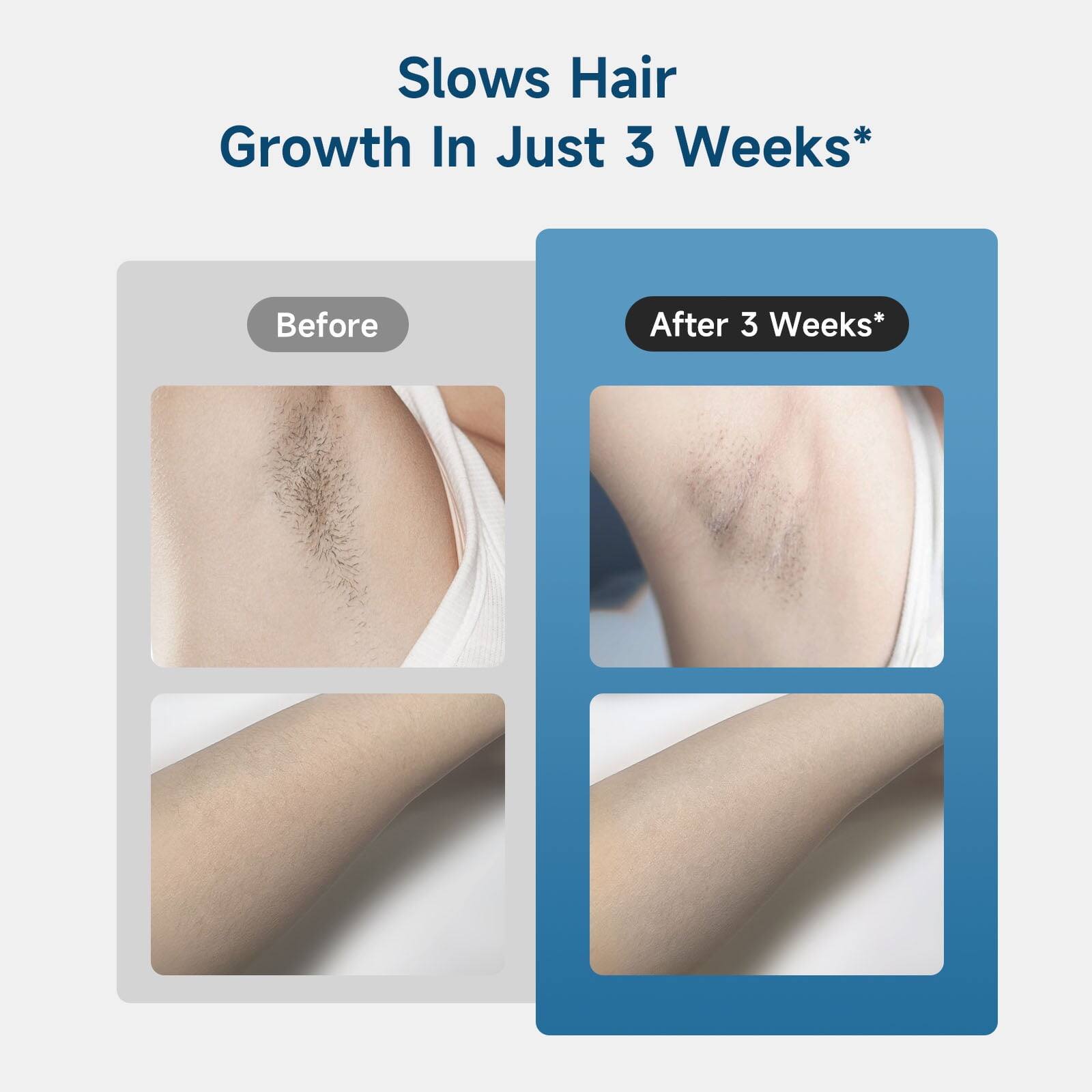 Slows Hair Growth In Just 3 Weeks*

Before

After 3 Weeks*
