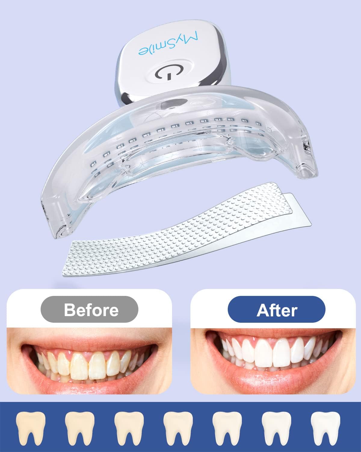 MySmile 1 Before After