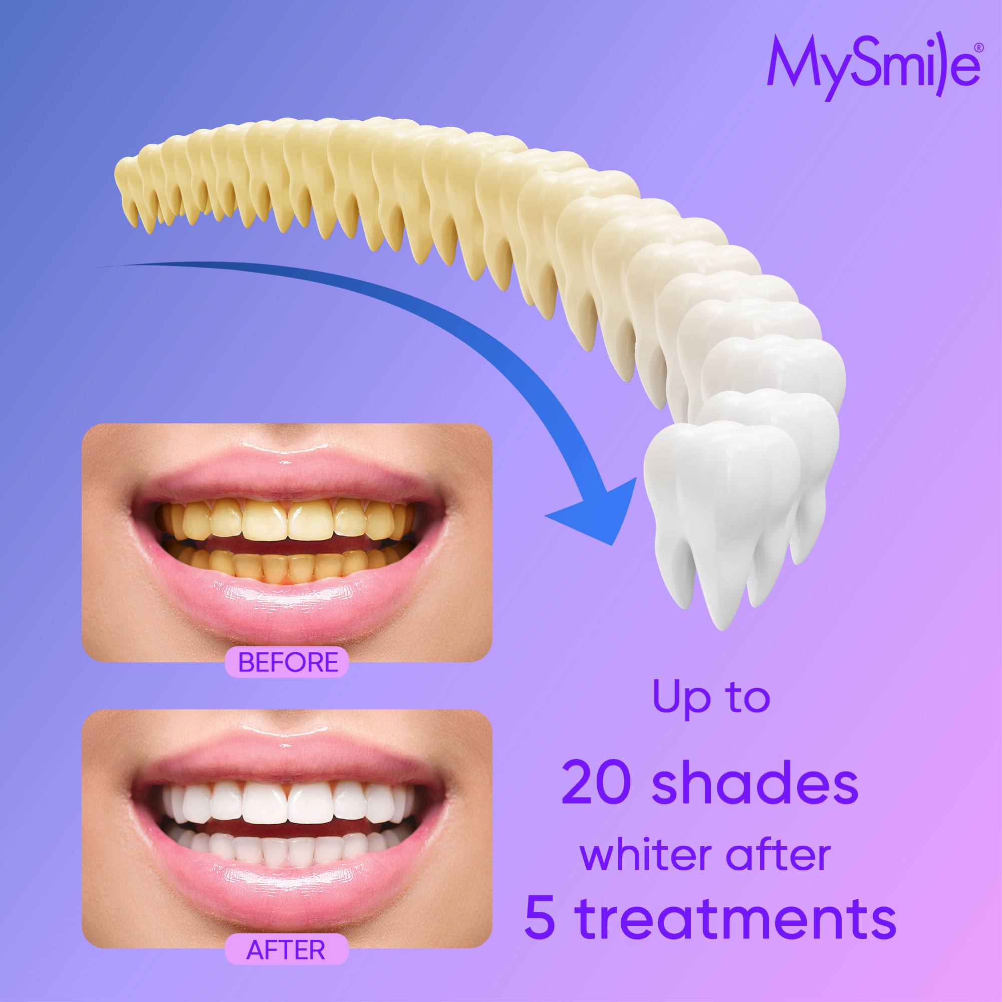 MySmile

BEFORE AFTER

Up to 20 shades whiter after 5 treatments