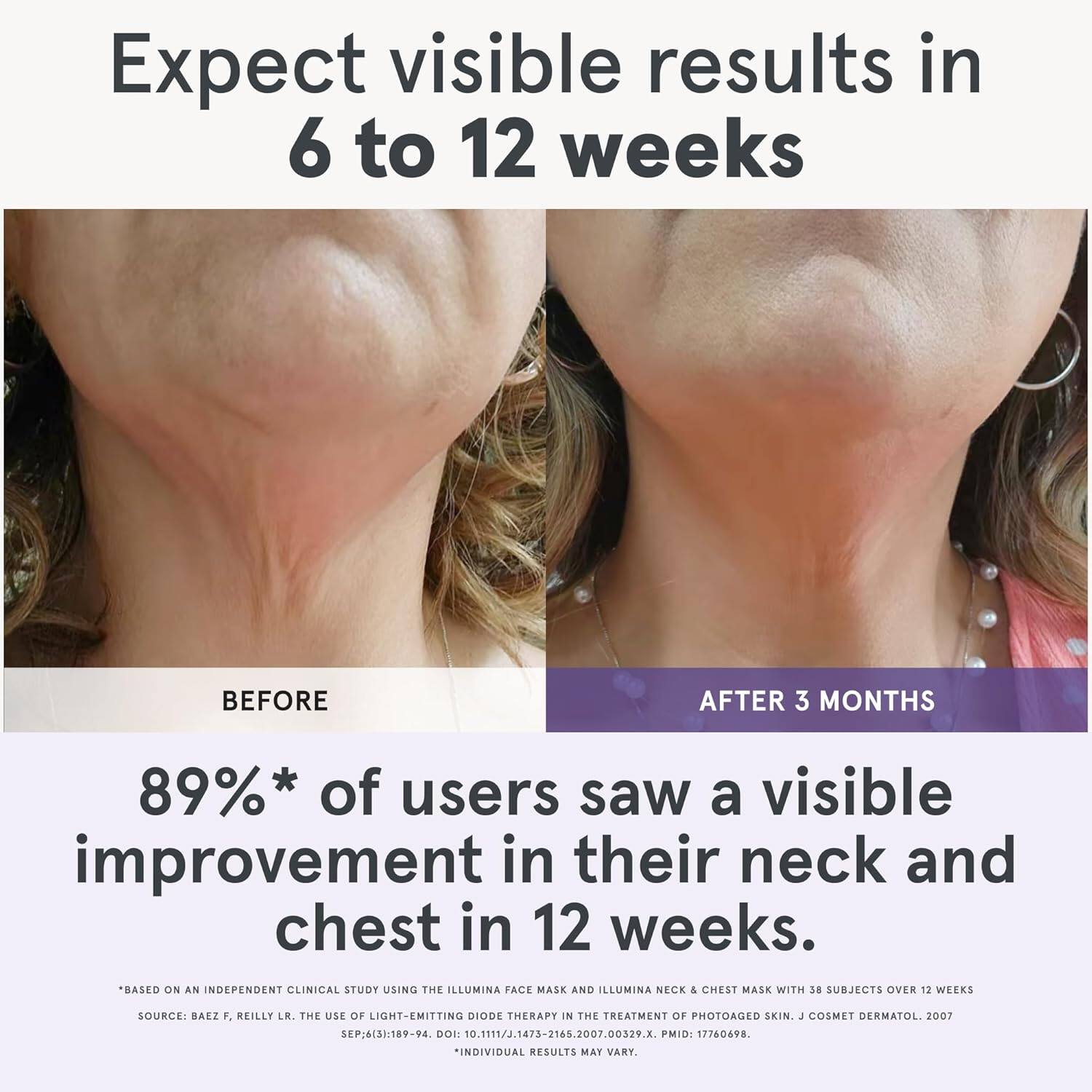 Expect visible results in 6 to 12 weeks

BEFORE

AFTER 3 MONTHS

89%* of users saw a visible improvement in their neck and chest in 12 weeks.

*Based on an independent clinical study using the Illumina Face Mask and Illumina Neck & Chest Mask with 38 subjects over 12 weeks
Source: Baez F, Reilly LR. The use of light-emitting diode therapy in the treatment of photoaged skin. J Cosmet Dermatol. 2007 Sep;6(3):189-94. DOI: 10.1111/j.1473-2166.2007.00329.x. PMID: 17760698
*Individual results may vary.