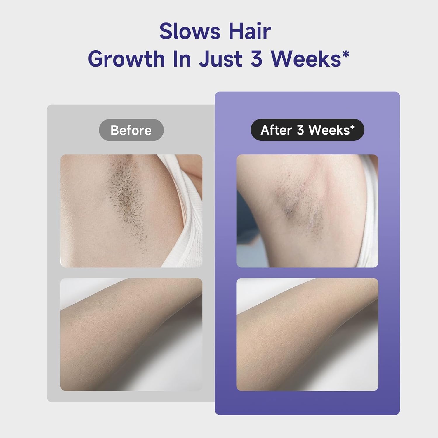 Slows Hair Growth In Just 3 Weeks*

Before

After 3 Weeks*