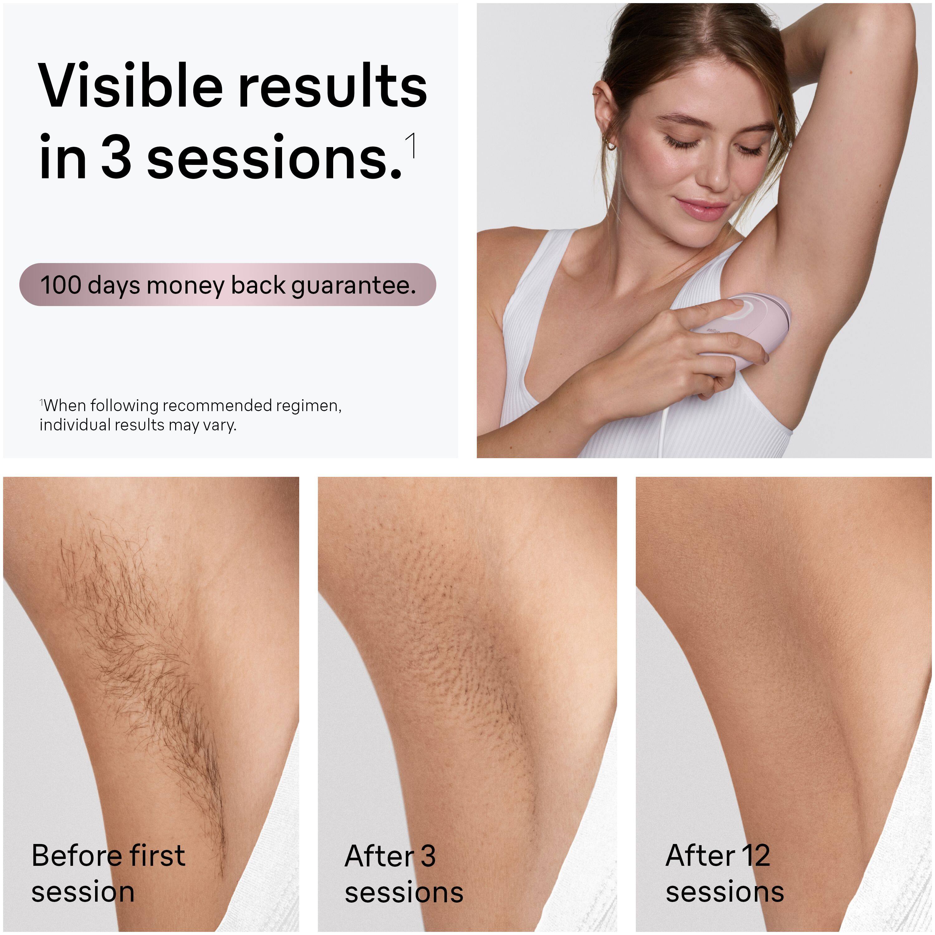 Visible results in 3 sessions.  
100 days money back guarantee.  

When following recommended regimen, individual results may vary.  

Before first session  
After 3 sessions  
After 12 sessions
