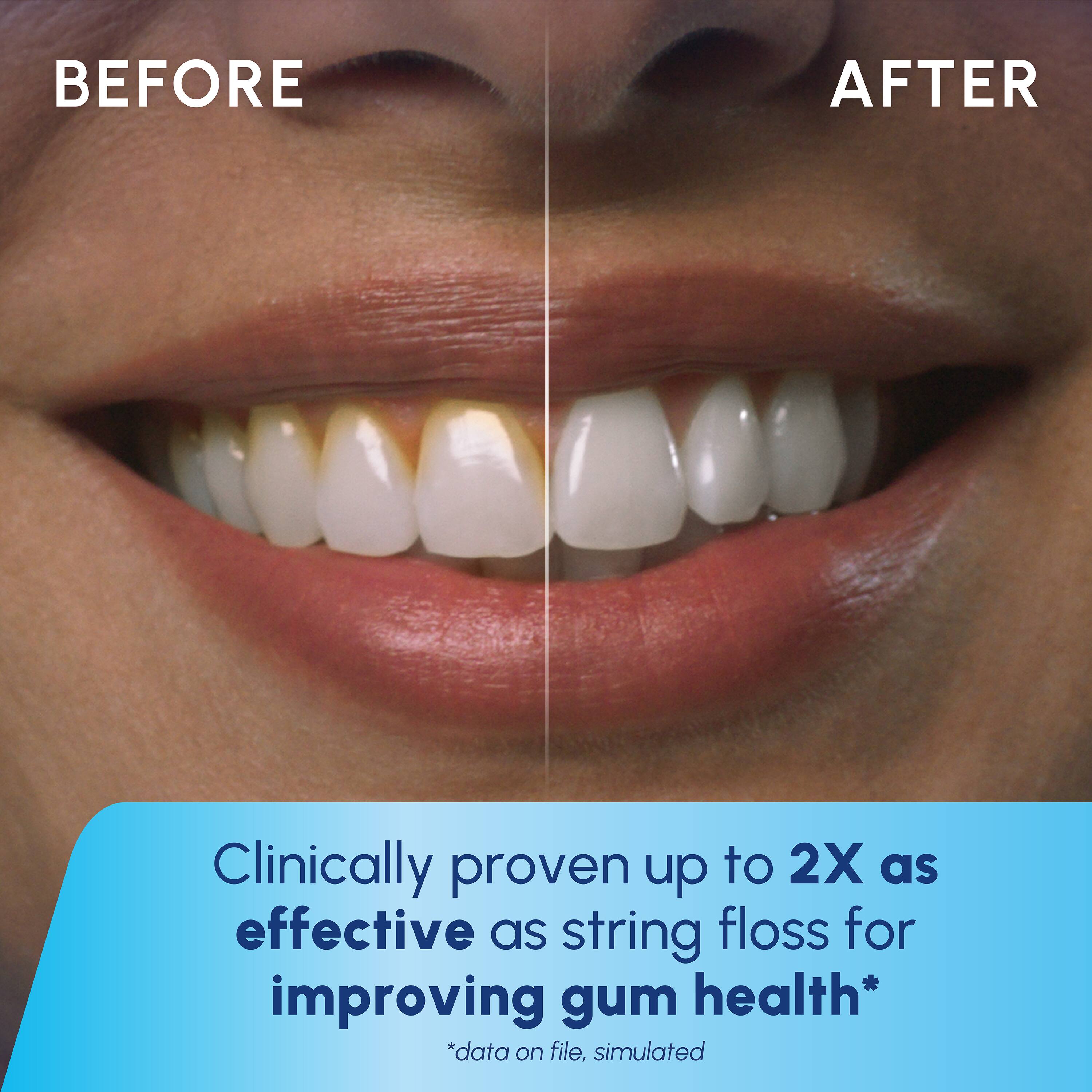 BEFORE AFTER

Clinically proven up to 2X as effective as string floss for improving gum health*

*data on file, simulated
