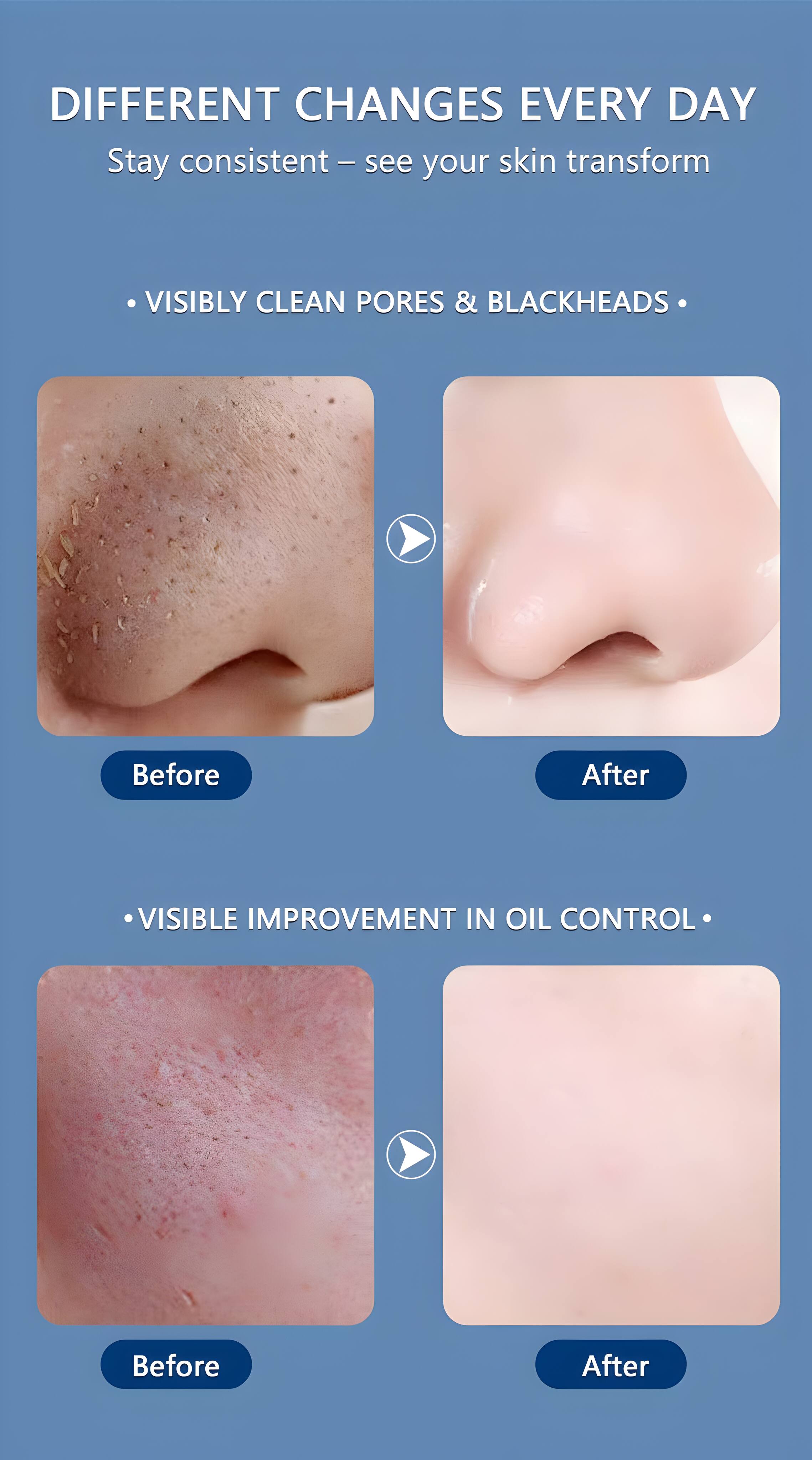 DIFFERENT CHANGES EVERY DAY  
Stay consistent - see your skin transform  

- VISIBLY CLEAN PORES & BLACKHEADS  
  Before After  

- VISIBLE IMPROVEMENT IN OIL CONTROL  
  Before After