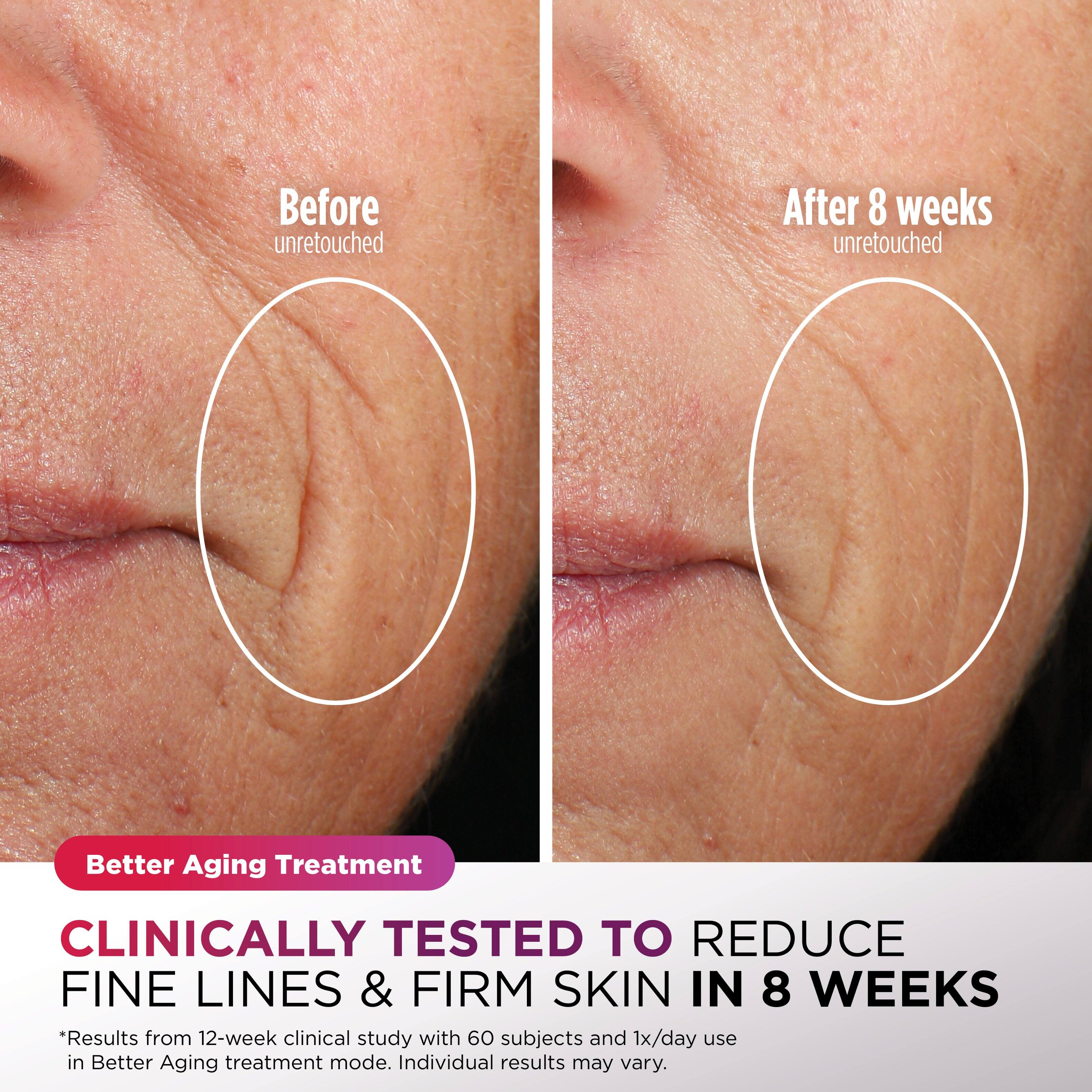 Before unretouched  
After 8 weeks unretouched  

Better Aging Treatment  

CLINICALLY TESTED TO REDUCE FINE LINES & FIRM SKIN IN 8 WEEKS  

*Results from 12-week clinical study with 60 subjects and 1x/day use in Better Aging treatment mode. Individual results may vary.