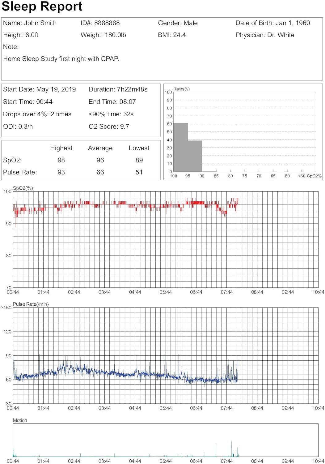 **Sleep Report**

- **Name:** John Smith  
- **ID#:** 88888888  
- **Gender:** Male  
- **Date of Birth:** Jan 1, 1960  
- **Height:** 6.0ft  
- **Weight:** 180.0lb  
- **BMI:** 24.4  
- **Physician:** Dr. White  

**Note:**  
Home Sleep Study first night with CPAP.

**Start Date:** May 19, 2019  
**Duration:** 7h22m48s  
**Start Time:** 00:44  
**End Time:** 08:07  

- Drops over 4%: 2 times  
- ODI: 0.3/h  
- <90% time: 32s  
- O2 Score: 9.7  

**SpO2:**  
- Highest: 98  
- Average: 96  
- Lowest: 89  

**Pulse Rate:**  
- Highest: 93  
- Average: 66  
- Lowest: 51  

**Graphs:**  
- Sp