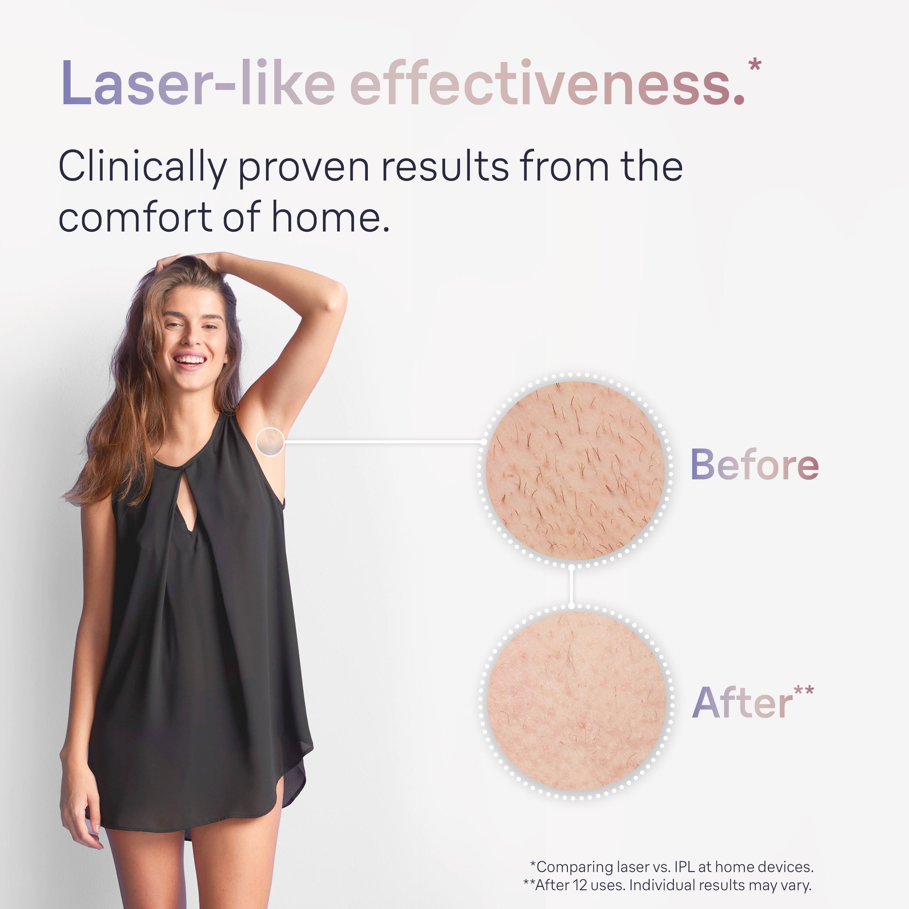 "Laser-like effectiveness. Clinically proven results from the comfort of home. Before and After. Comparing laser vs. IPL at home devices. After 12 uses. Individual results may vary."