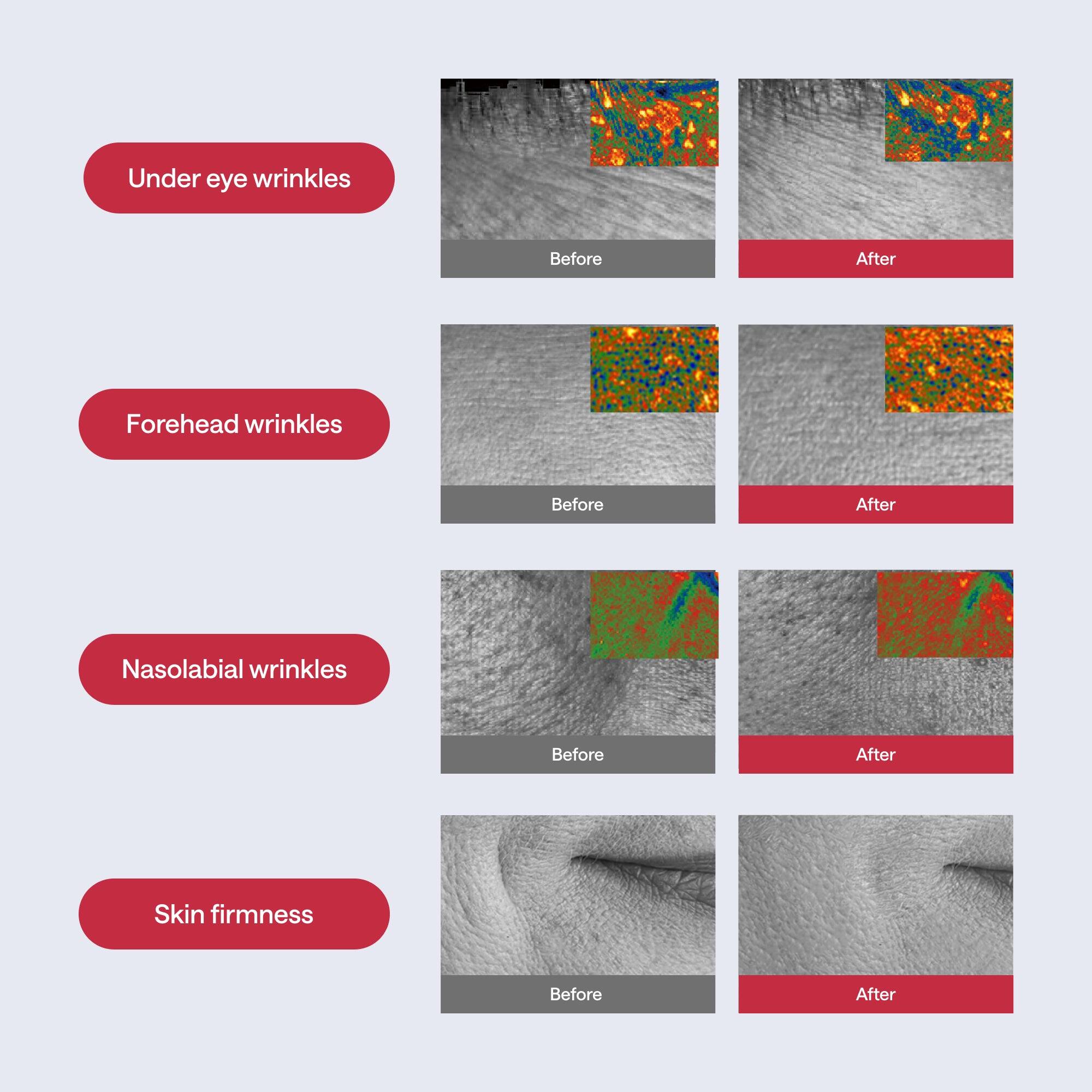 - Under eye wrinkles: Before After
- Forehead wrinkles: Before After
- Nasolabial wrinkles: Before After
- Skin firmness: Before After