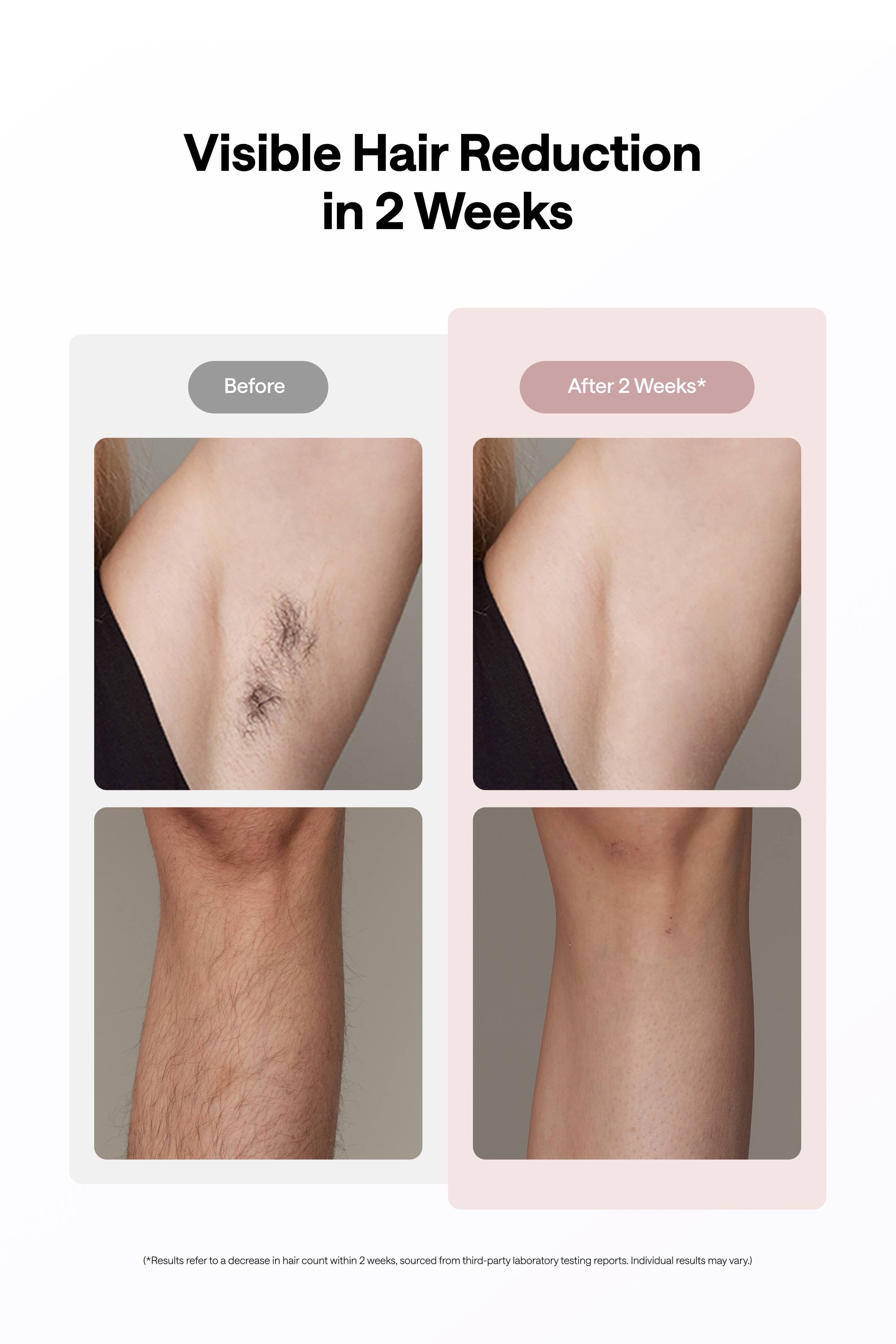 Visible Hair Reduction in 2 Weeks

Before

After 2 Weeks*

*Results refer to a decrease in hair count within 2 weeks, sourced from third-party laboratory testing reports. Individual results may vary.