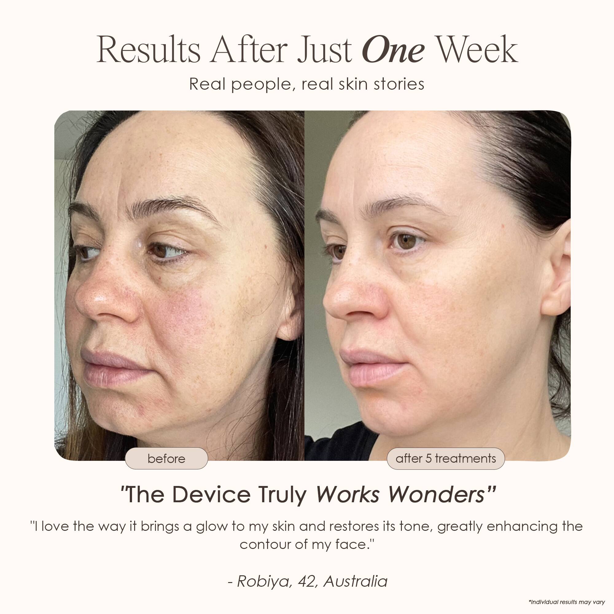 Results After Just One Week  
Real people, real skin stories  

before  
after 5 treatments  

"The Device Truly Works Wonders"  
"I love the way it brings a glow to my skin and restores its tone, greatly enhancing the contour of my face."  
- Robiya, 42, Australia  

*Individual results may vary