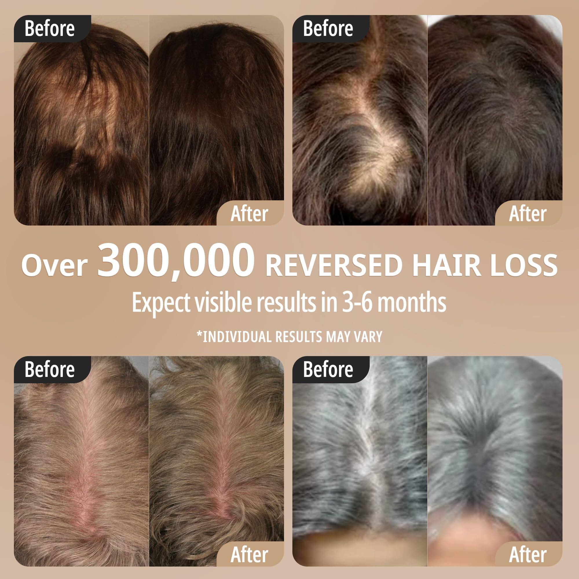 Before Before After After Over 300,000 REVERSED HAIR LOSS Expect visible results in 3-6 months *INDIVIDUAL RESULTS MAY VARY Before Before After After