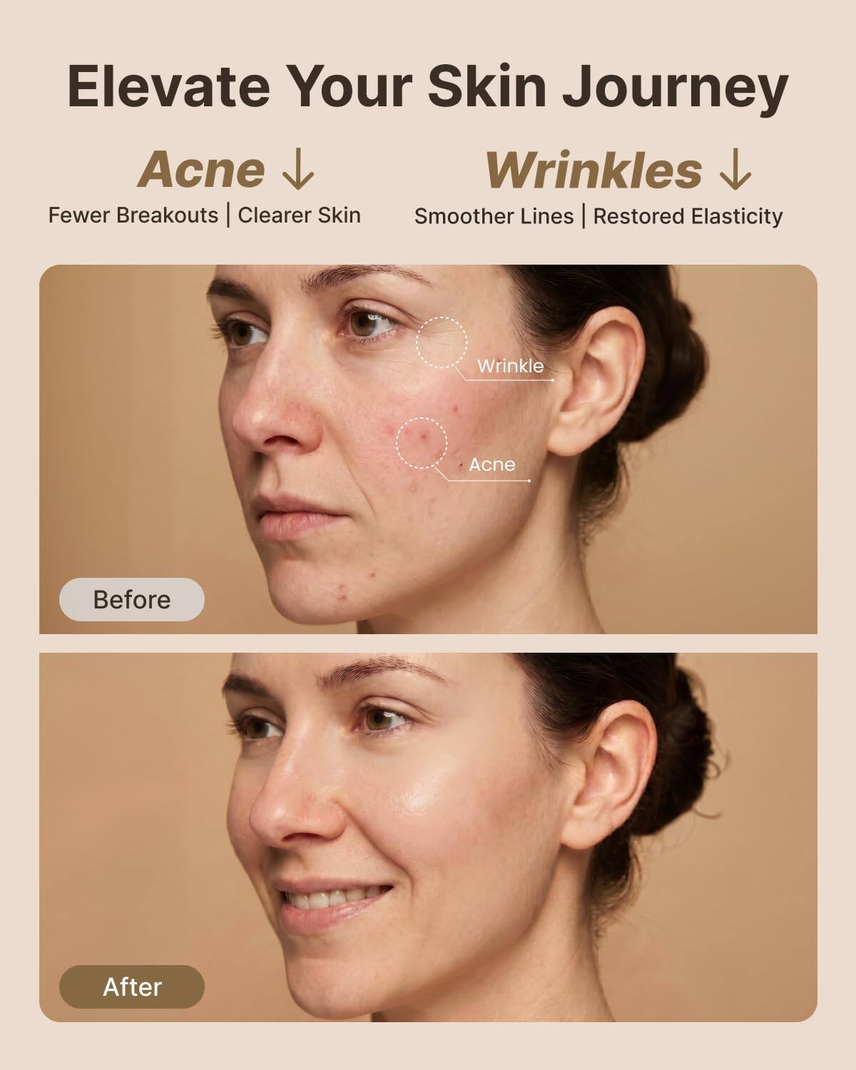 Elevate Your Skin Journey

Acne ↓
Fewer Breakouts | Clearer Skin

Wrinkles ↓
Smother Lines | Restored Elasticity

Before

After