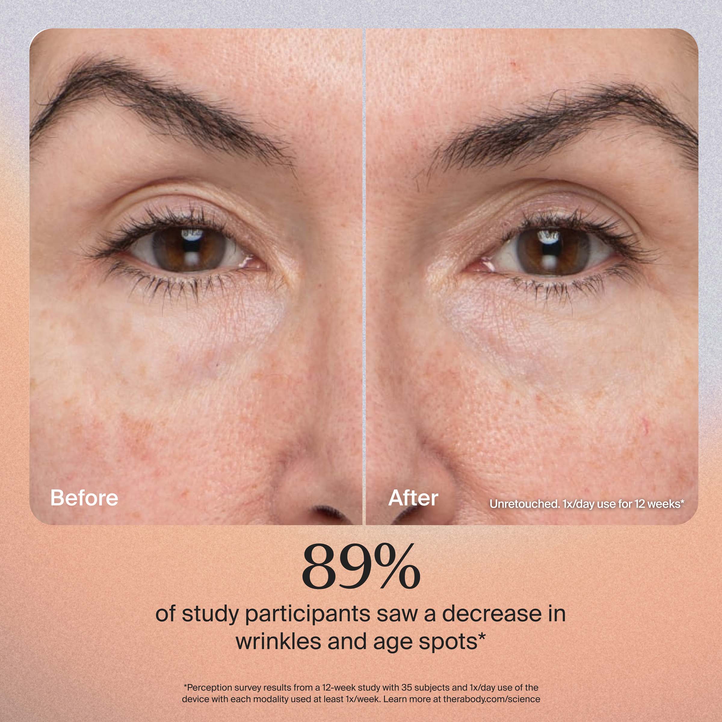 Before After Unretouched. 1x/day use for 12 weeks*  
89% of study participants saw a decrease in wrinkles and age spots*  
*Perception survey results from a 12-week study with 35 subjects and 1x/day use of the device with each modality used at least 1x/week. Learn more at therabody.com/science