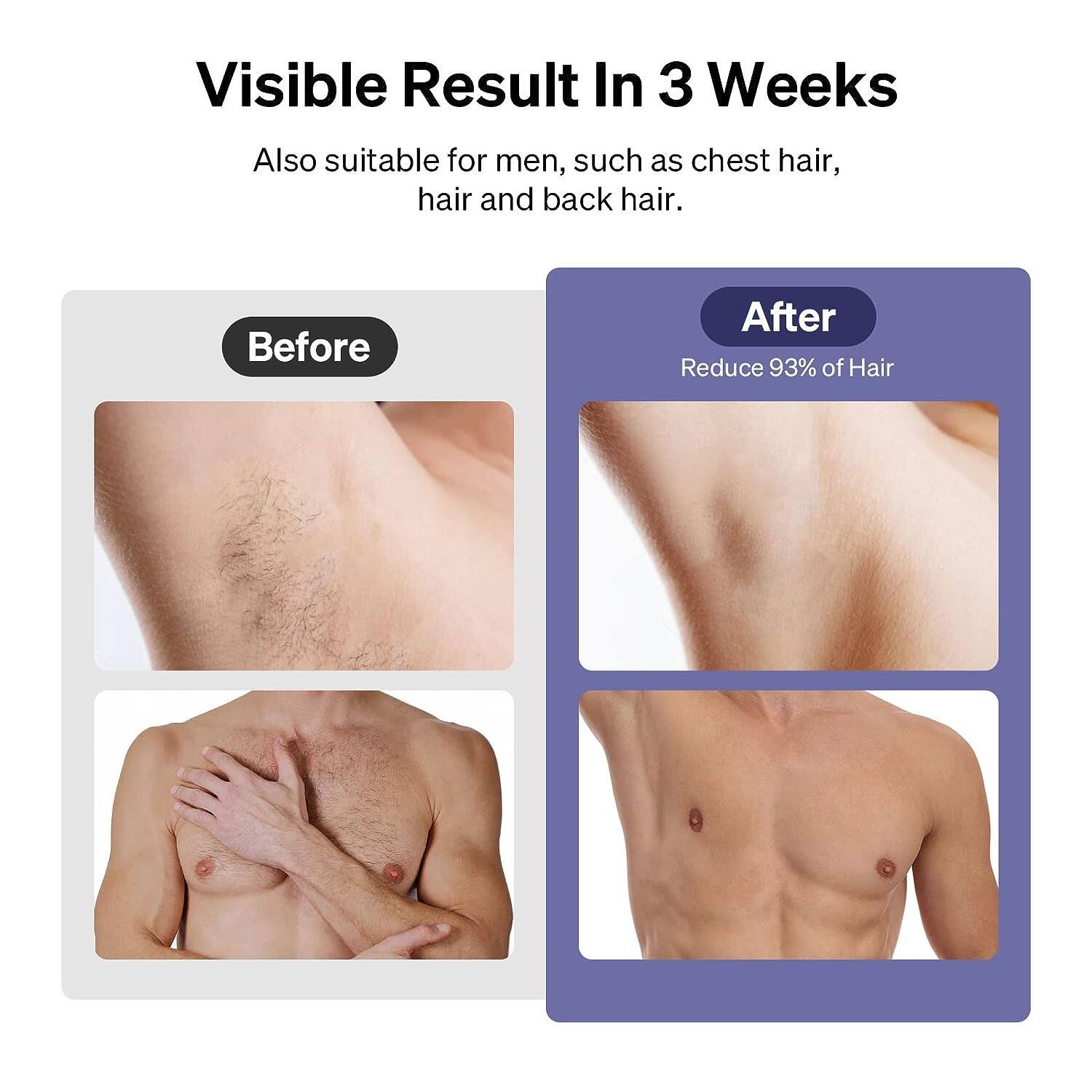 Visible Result In 3 Weeks

Also suitable for men, such as chest hair, hair and back hair.

Before

After

Reduce 93% of Hair