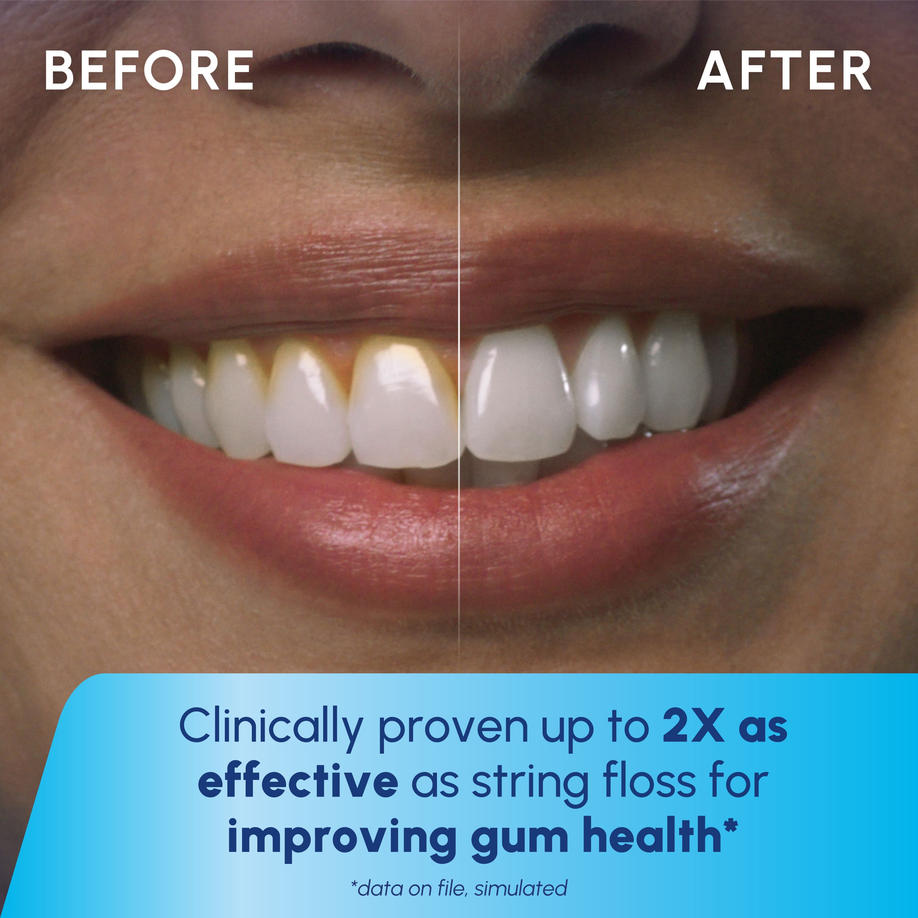 BEFORE AFTER Clinically proven up to 2X as effective as string floss for improving gum health* *data on file. simulated